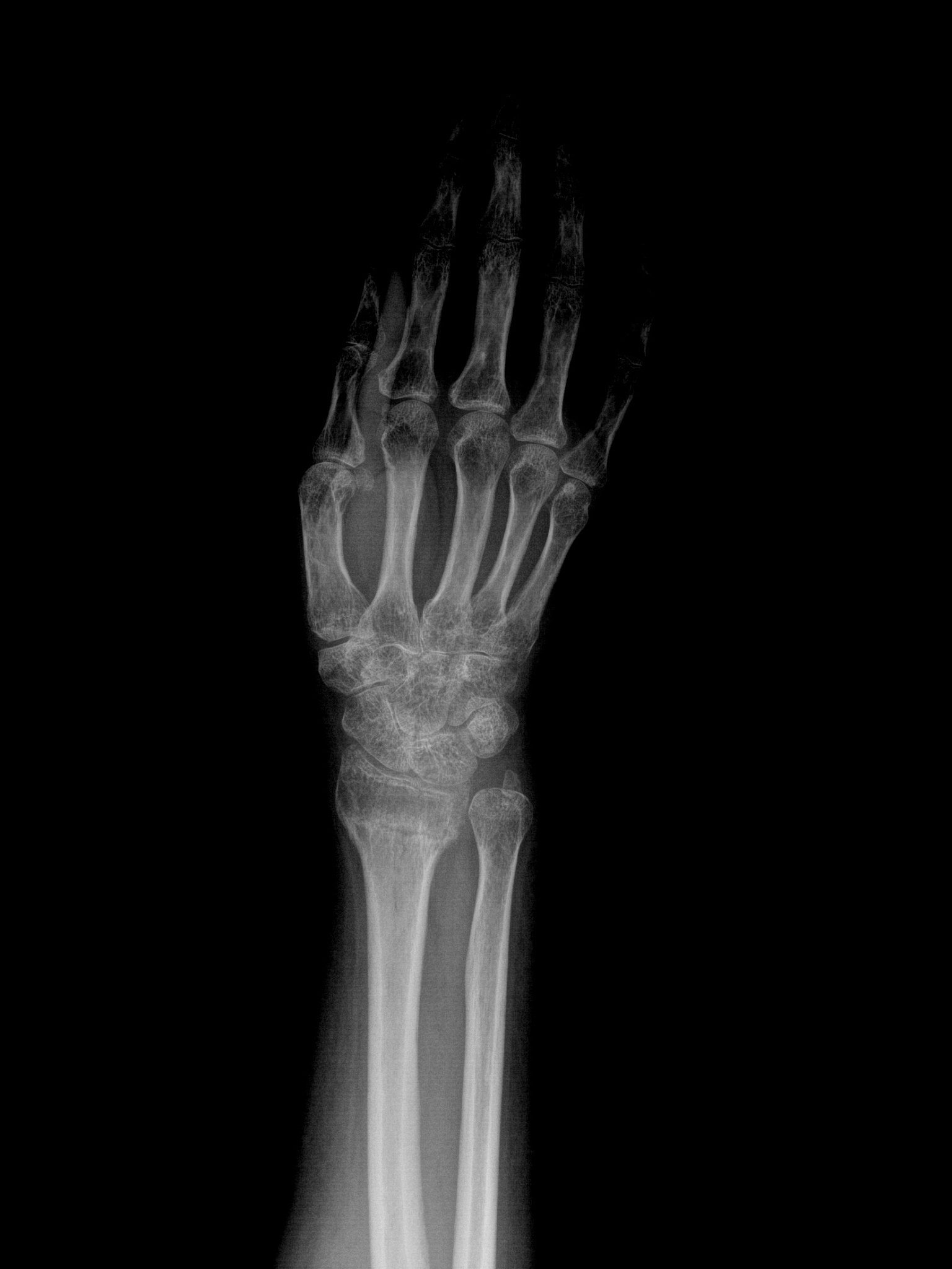 手腕损伤类型：舟骨骨折