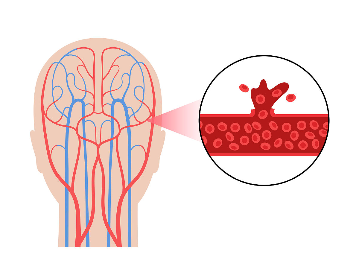 对于脑出血肌张力最详细的康复书籍回答+拓展