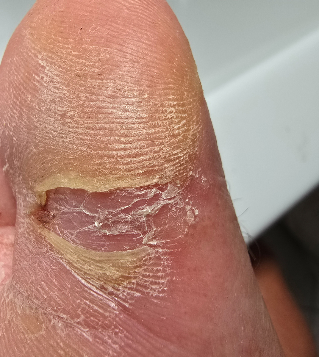 脚气的主要成分