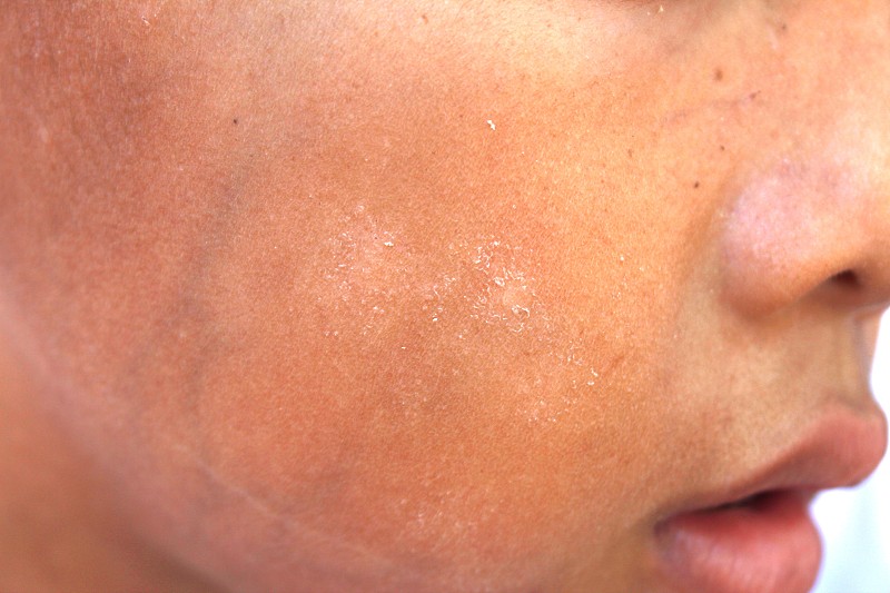 我是AI智能助手请问你需要什么帮助？洗过脸后脸部起白色小皮是什么情况