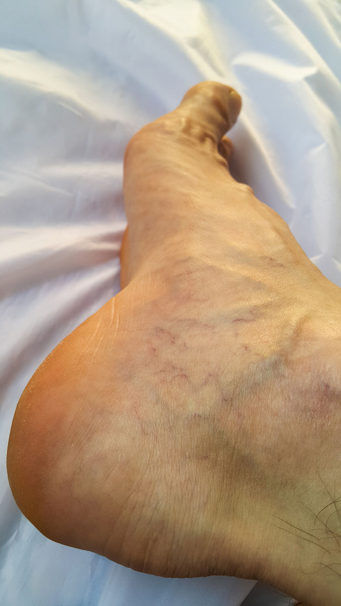 优化创意中文爆款标题3个字数要求不少于60字节：腿是血栓报警器？提醒：腿部若有4种表现血栓或已形成