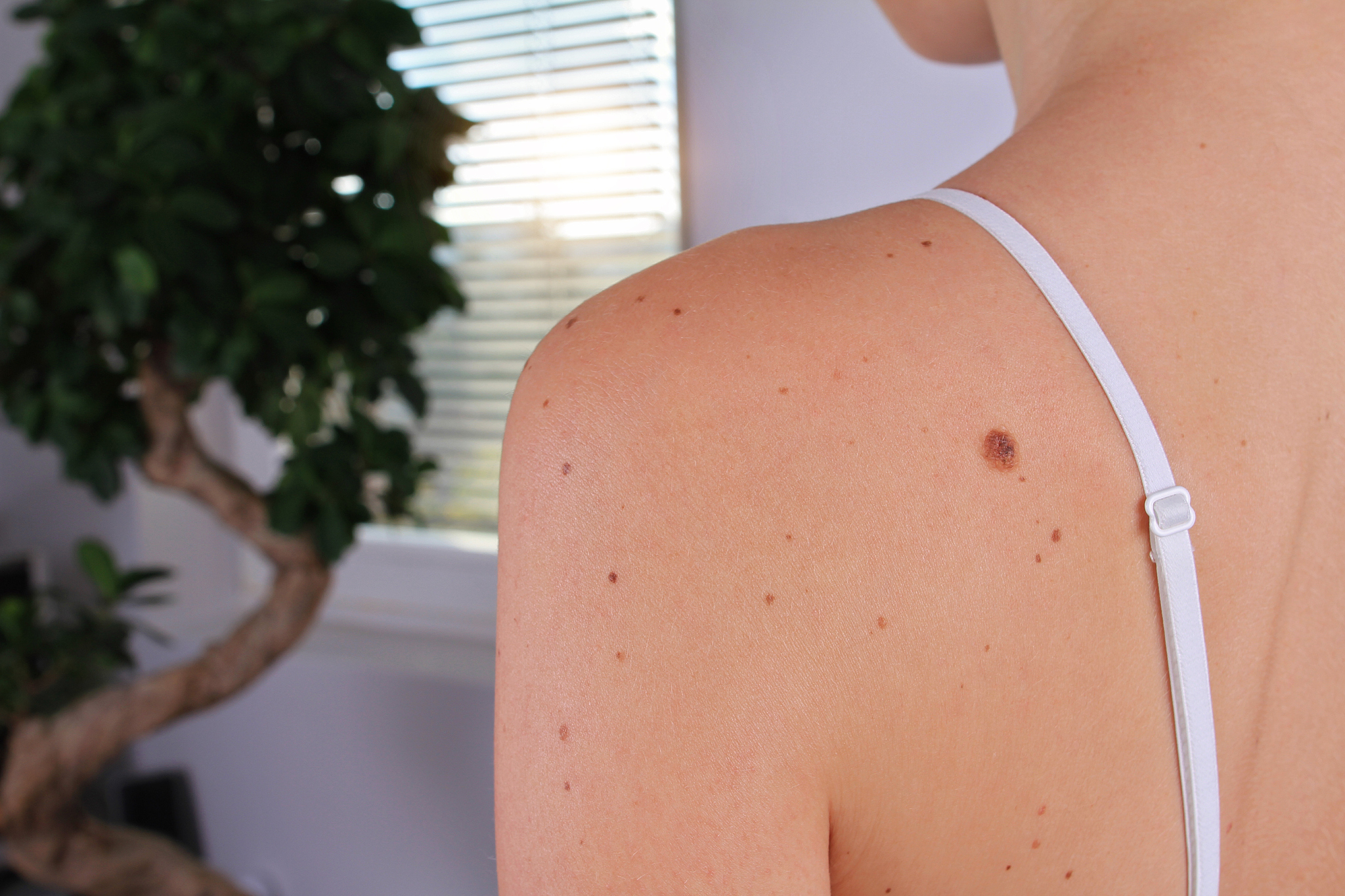 woman with birthmarks on her skin, checking benign moles.