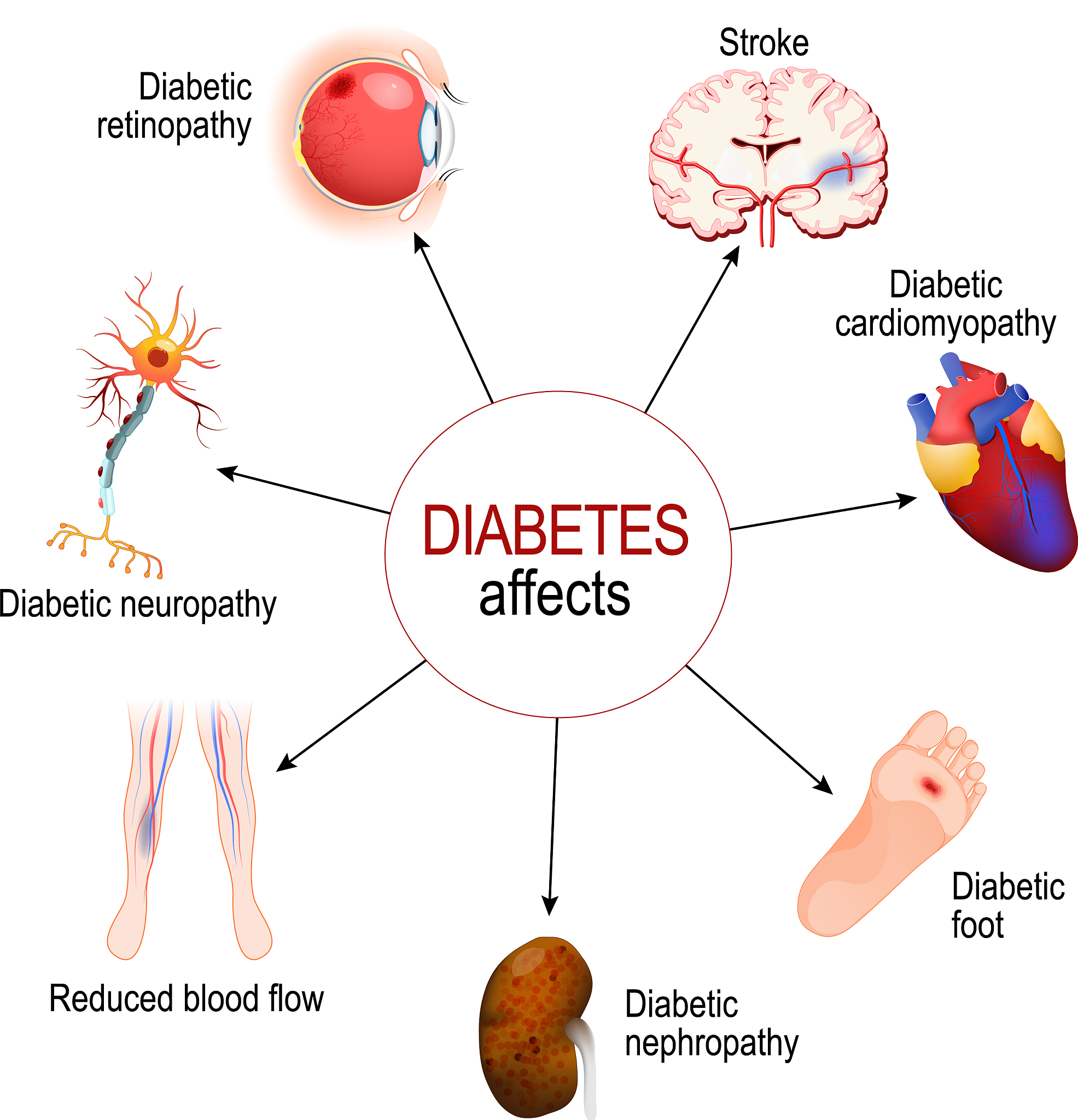 糖尿病肾病 1期到2期可以逆转吗