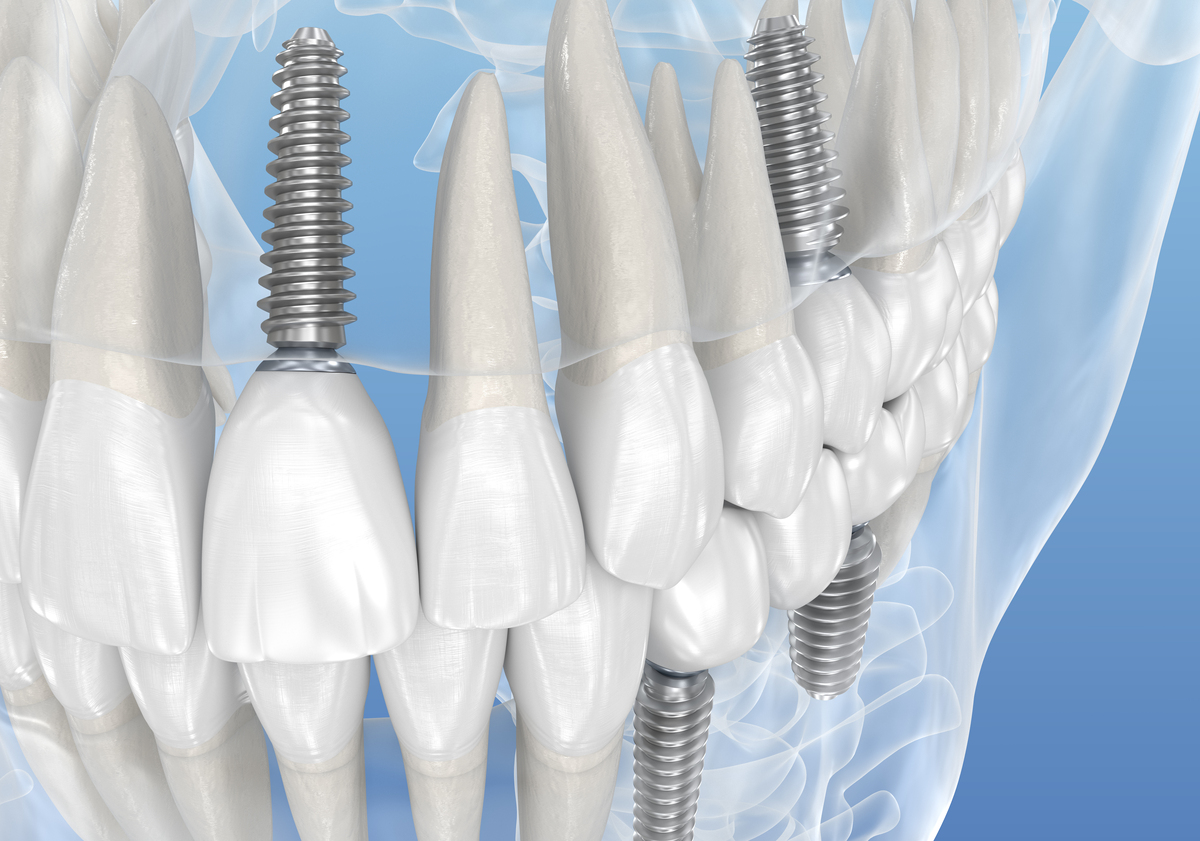 士卓曼的软组织水平种植体和骨水平种植体