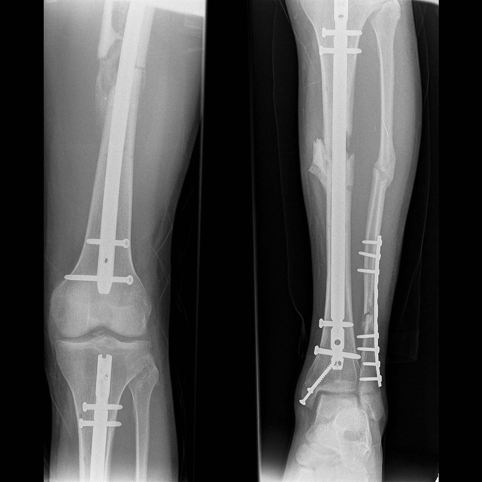 高龄髋部骨折患者治疗研究纳入与排除标准 - 全面解析