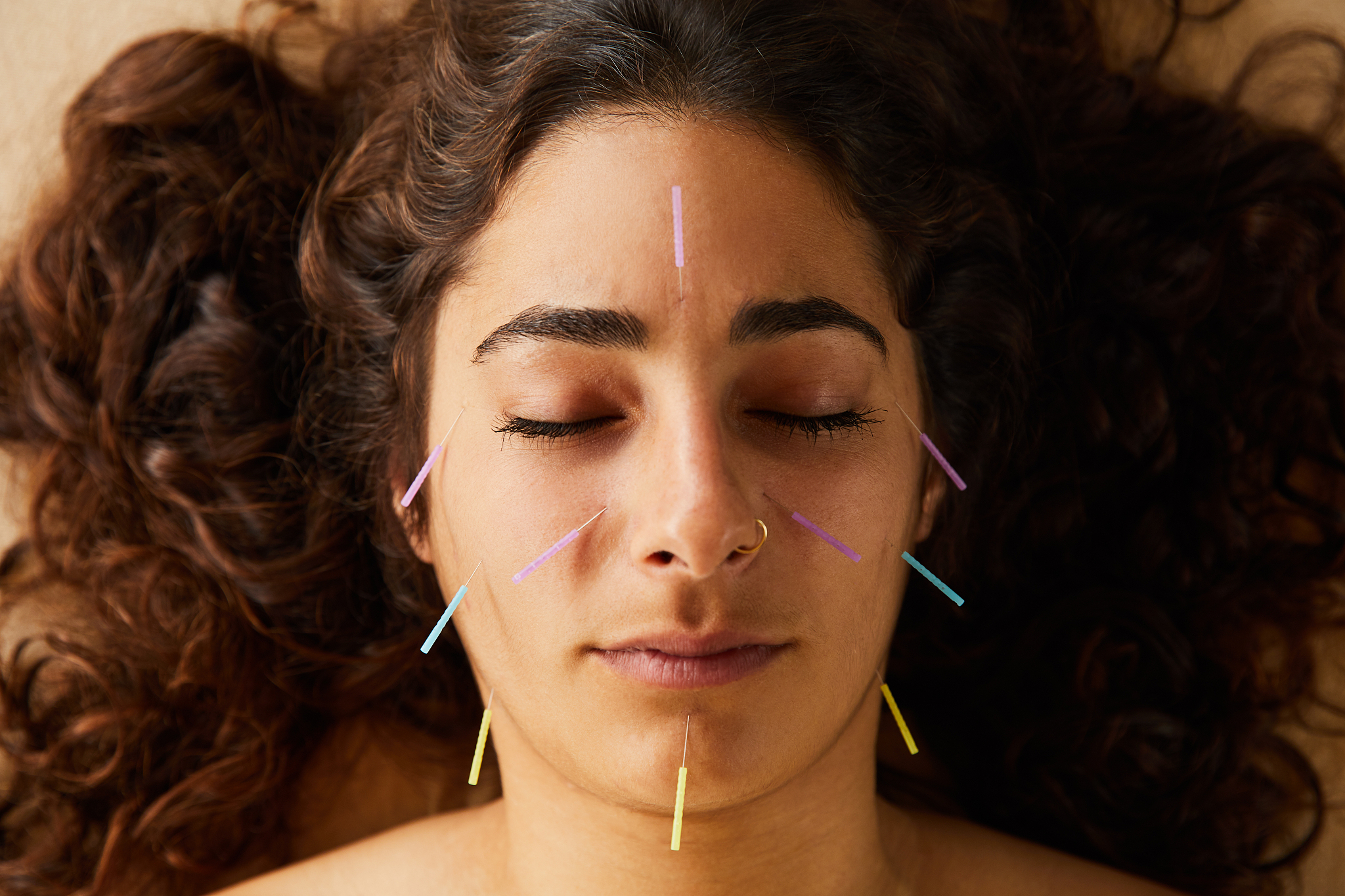 brunette woman having an acupuncture treatment on her face