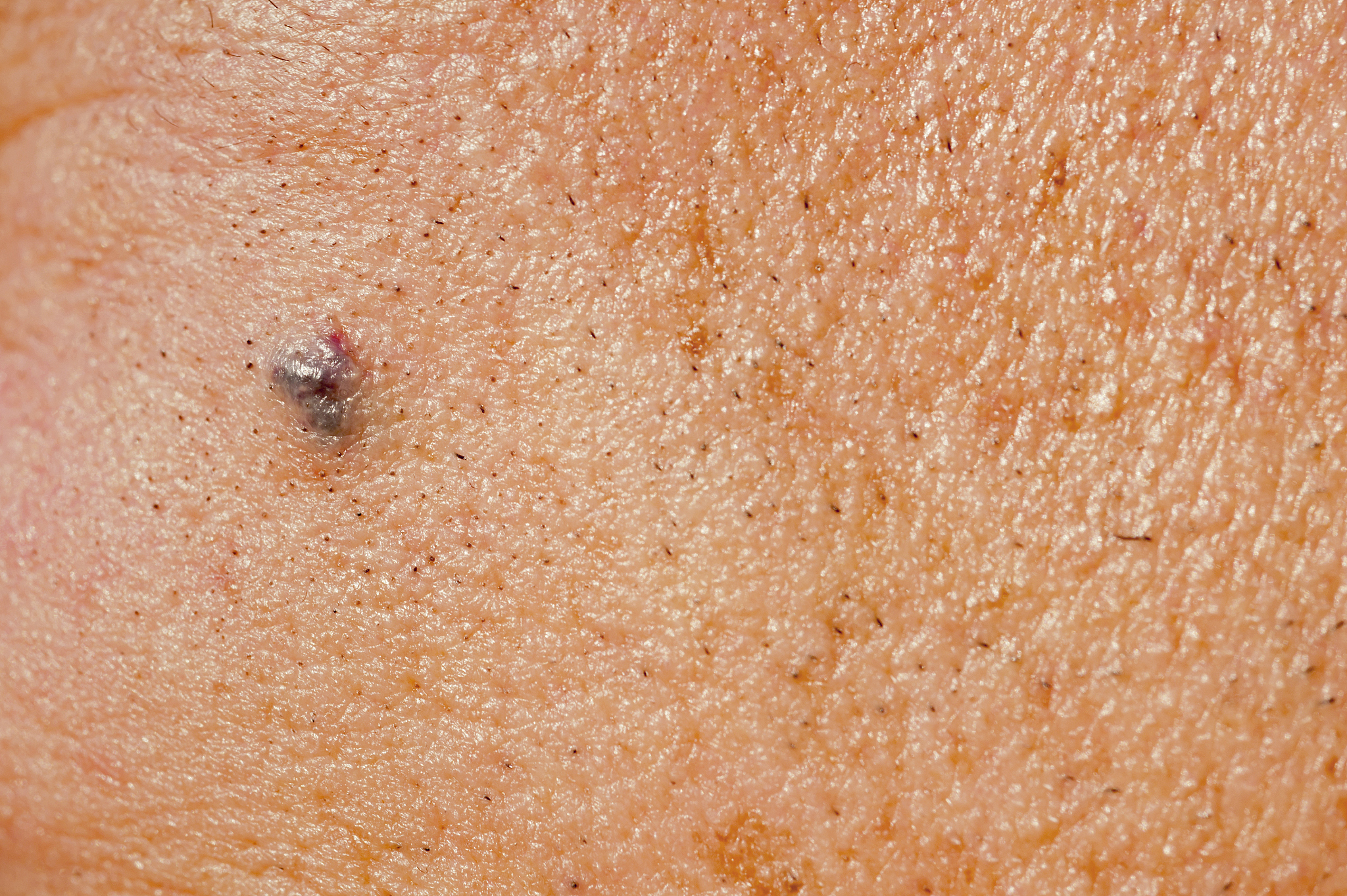 moles