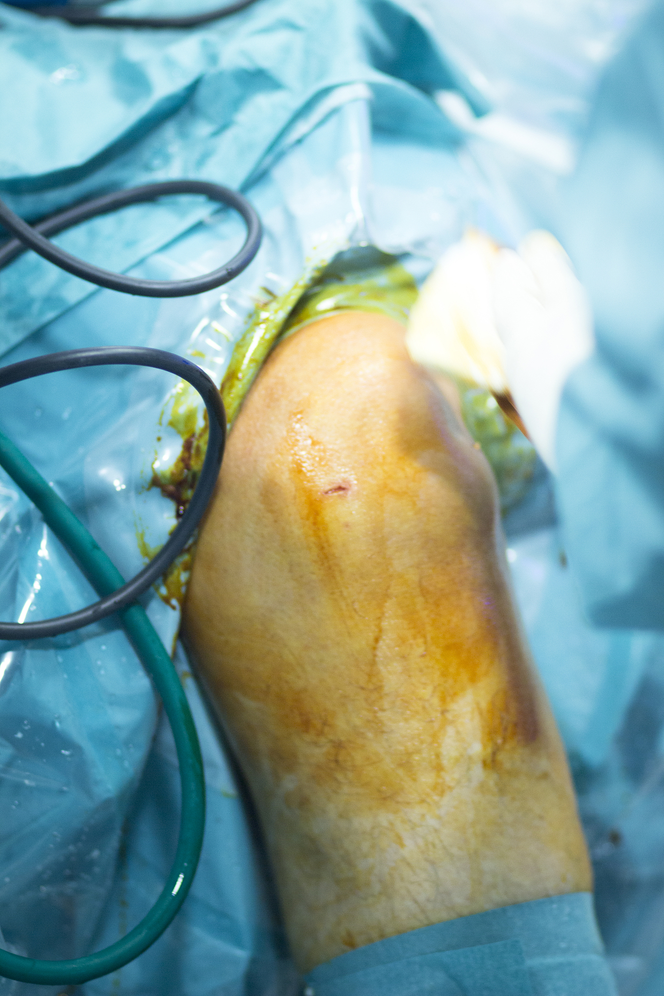 踝关节镜LassoLoop手术步骤：详细指南