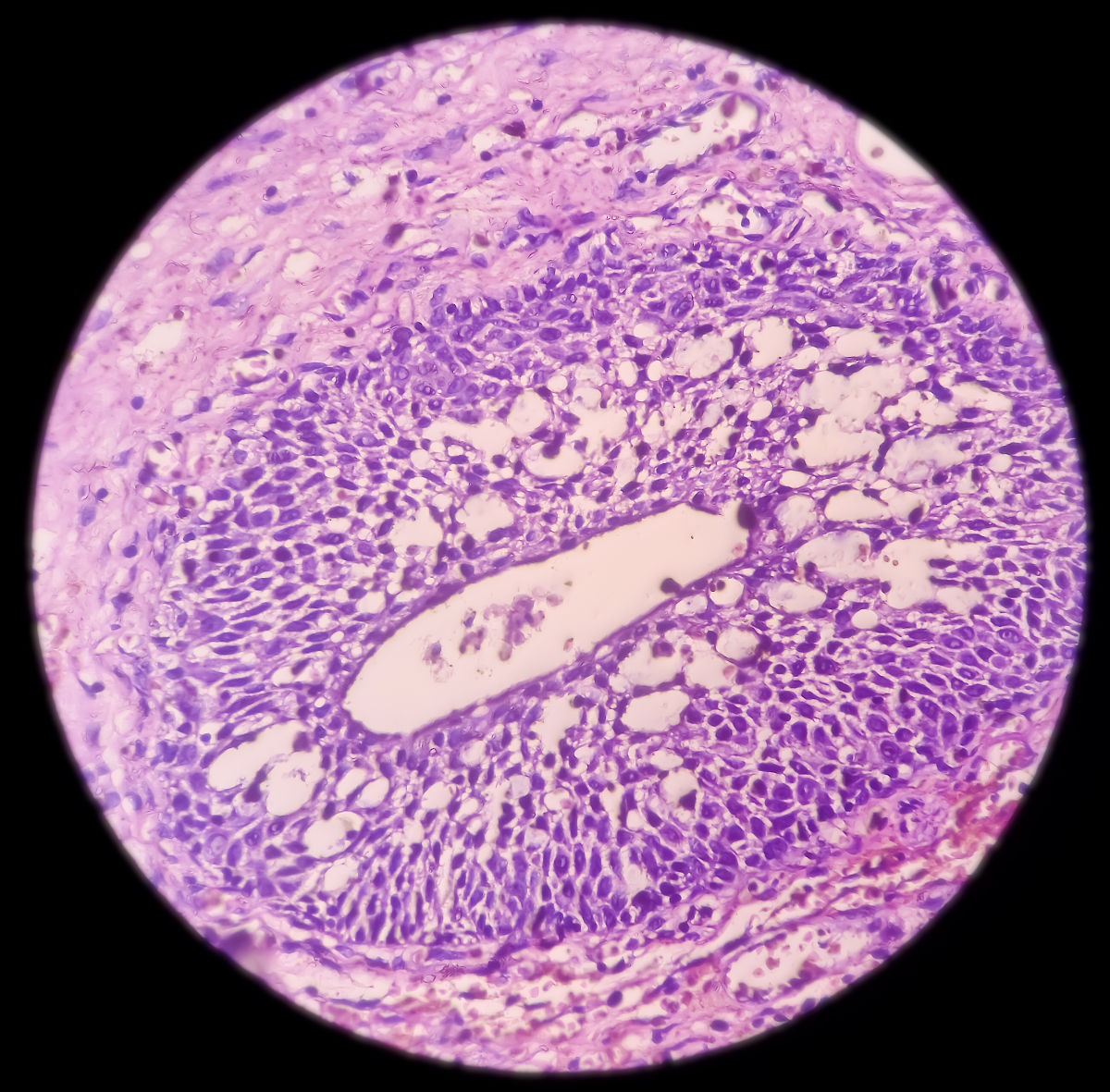 子宫内膜息肉需要手术吗？ - 了解手术治疗的5大益处