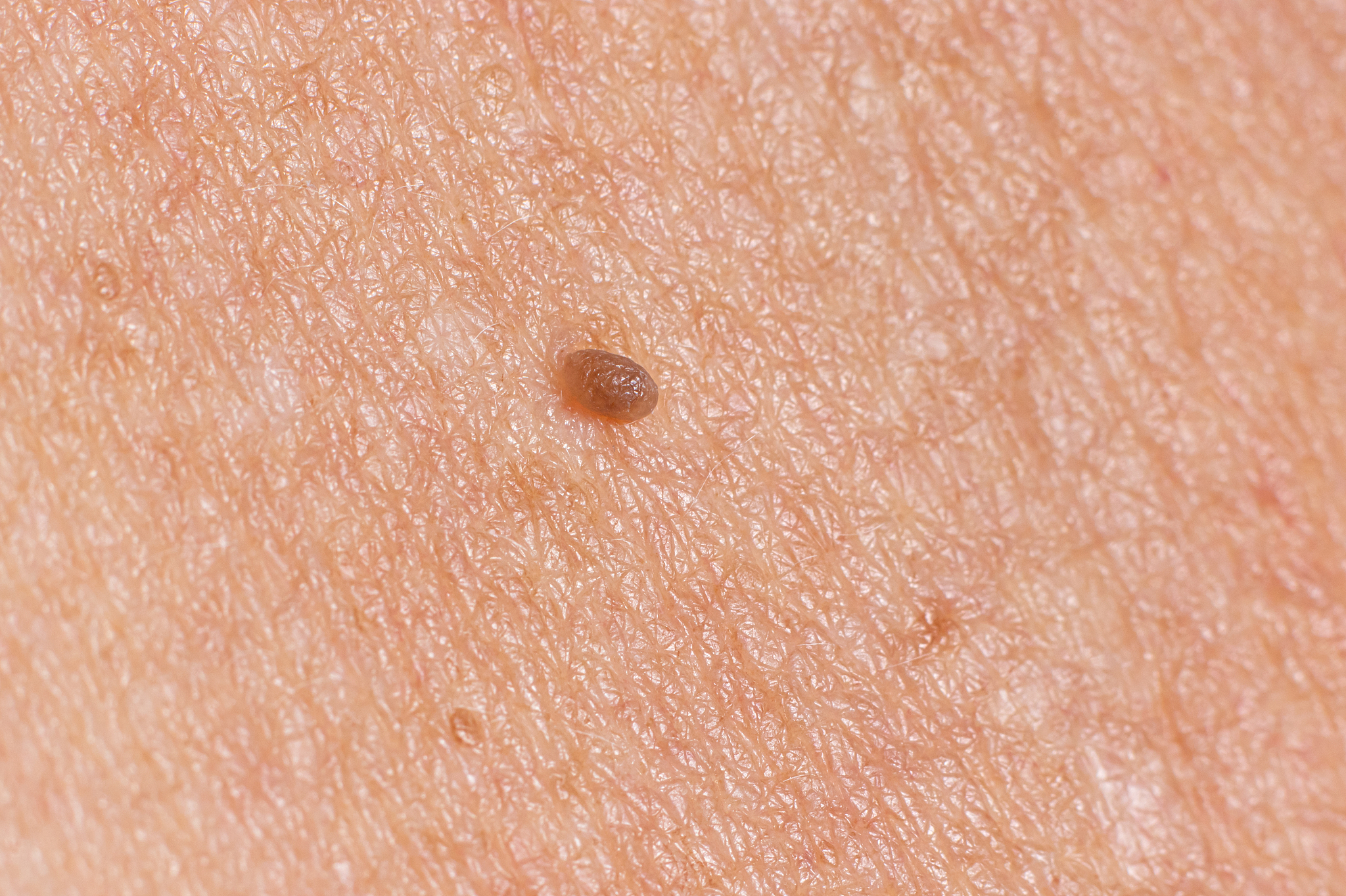 papilloma on human skin - benign tumor in the form of mole, nevu