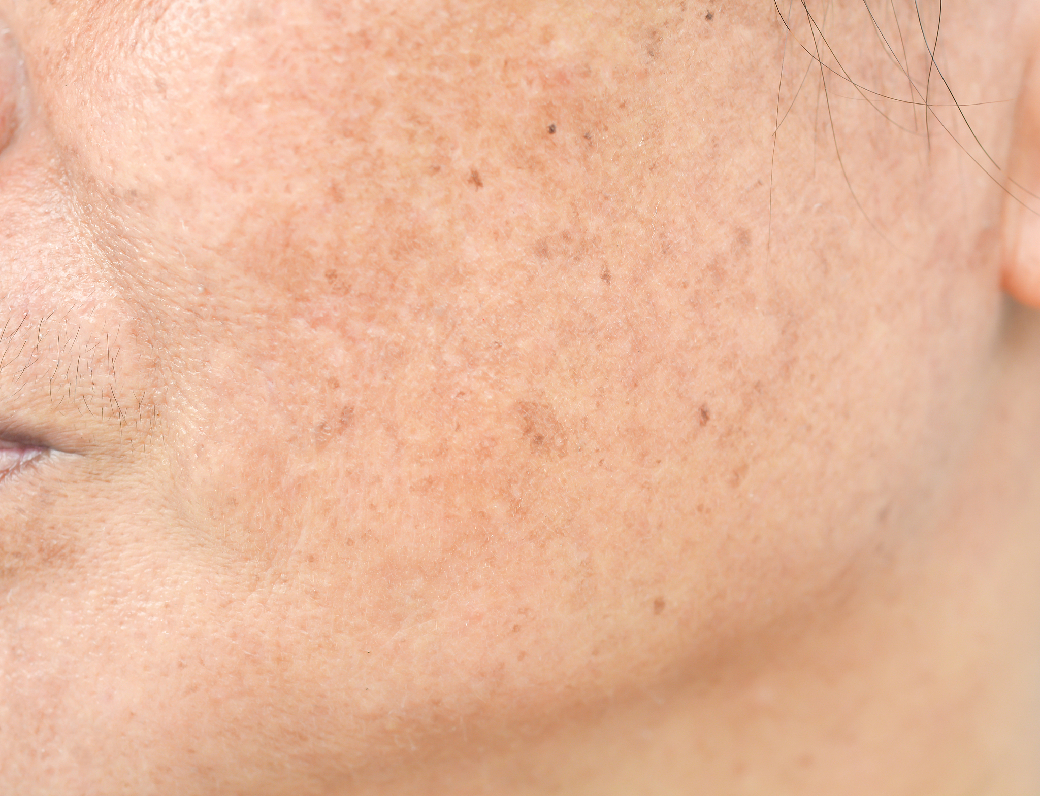 freckles on the face