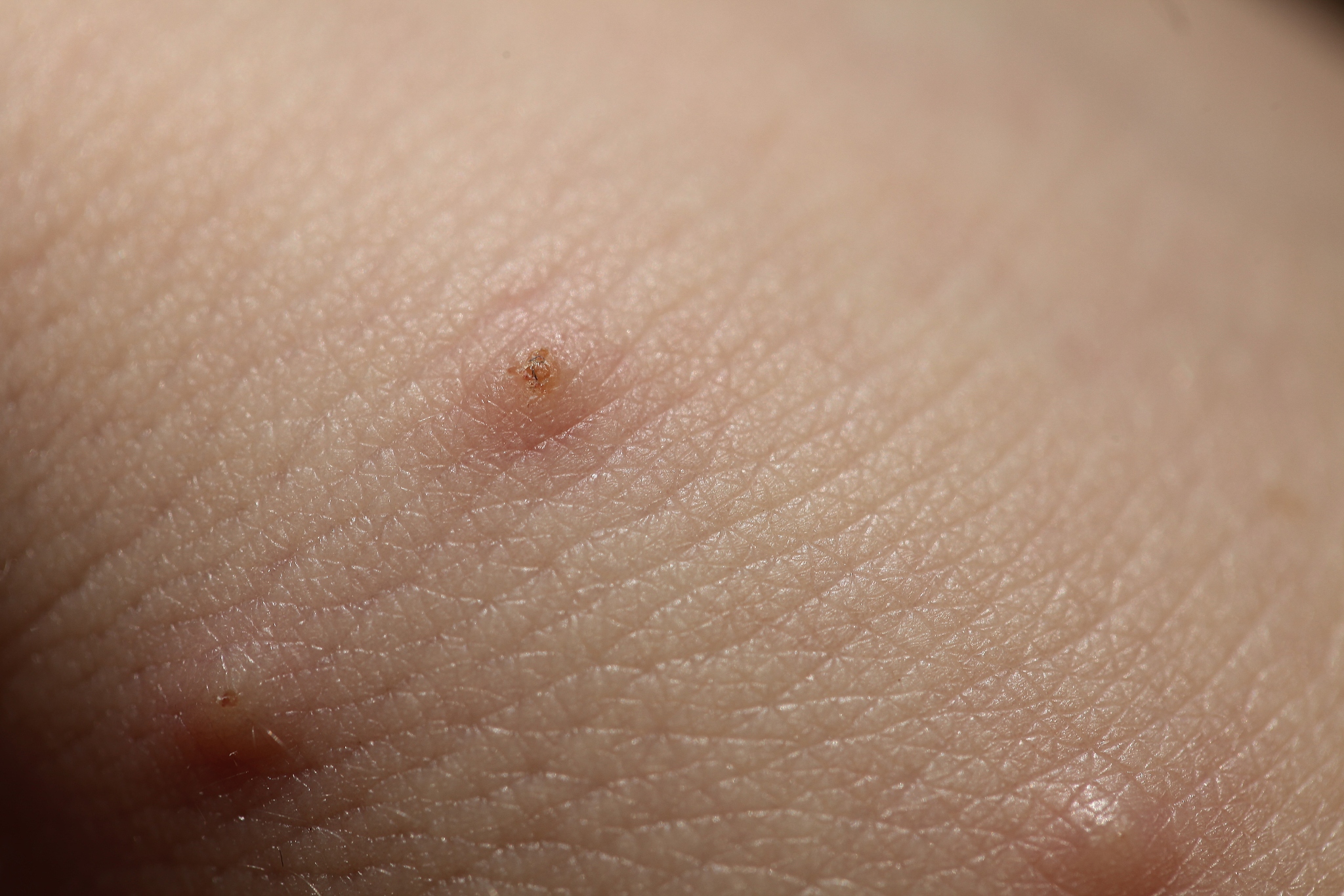 insect bites on  skin  child