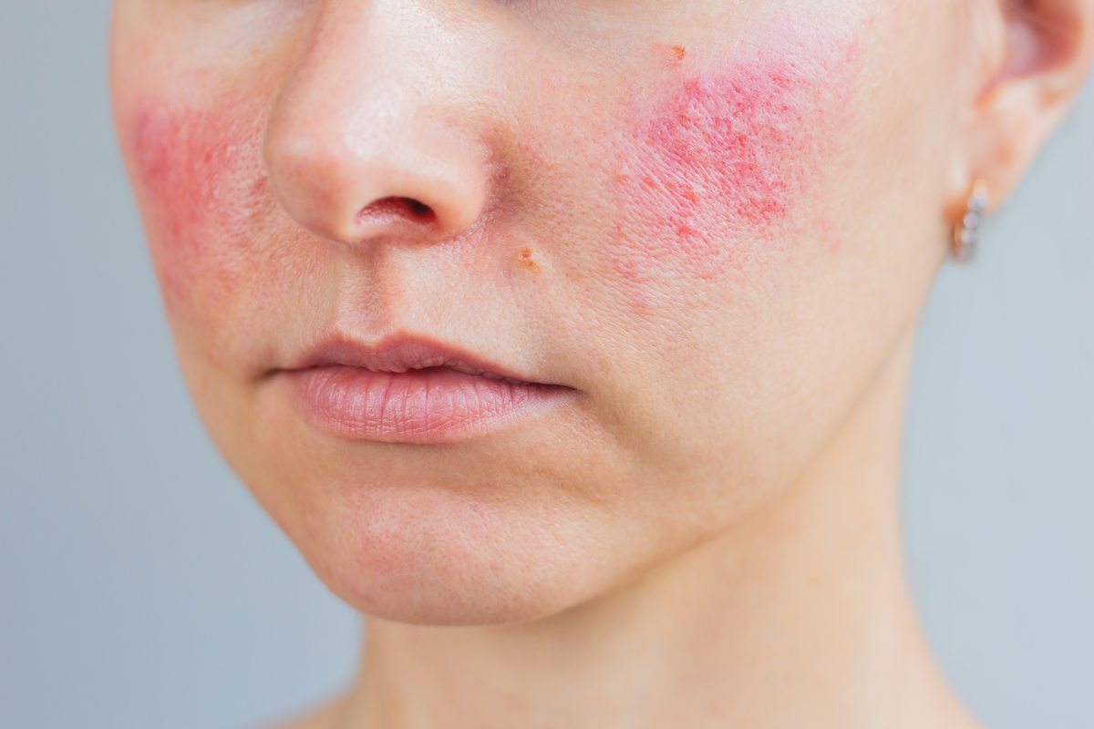 去角质产品的副作用：过度使用会伤害你的皮肤！