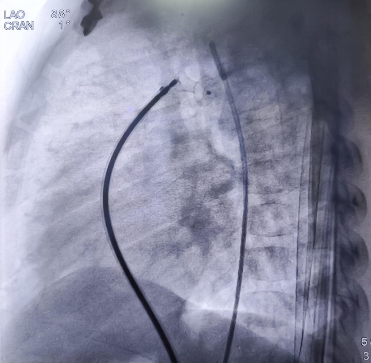 喘振、管外颈缩、向上球型脱落、向上T型脱落