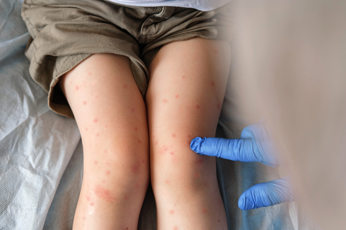 荨麻疹：症状、原因和治疗方法