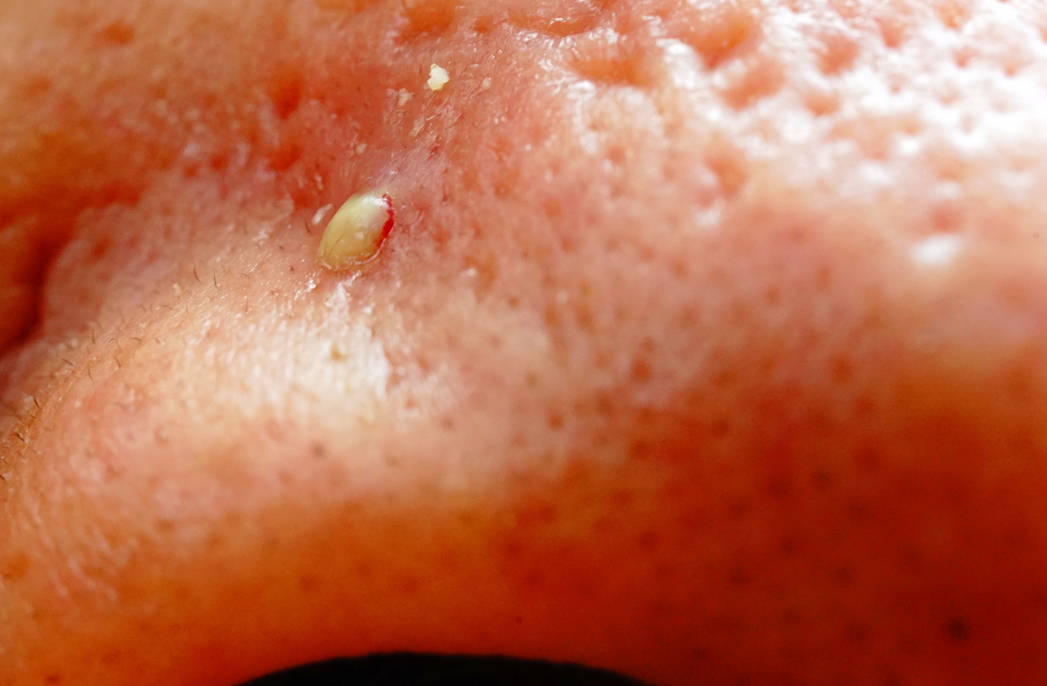 big pimple on nose