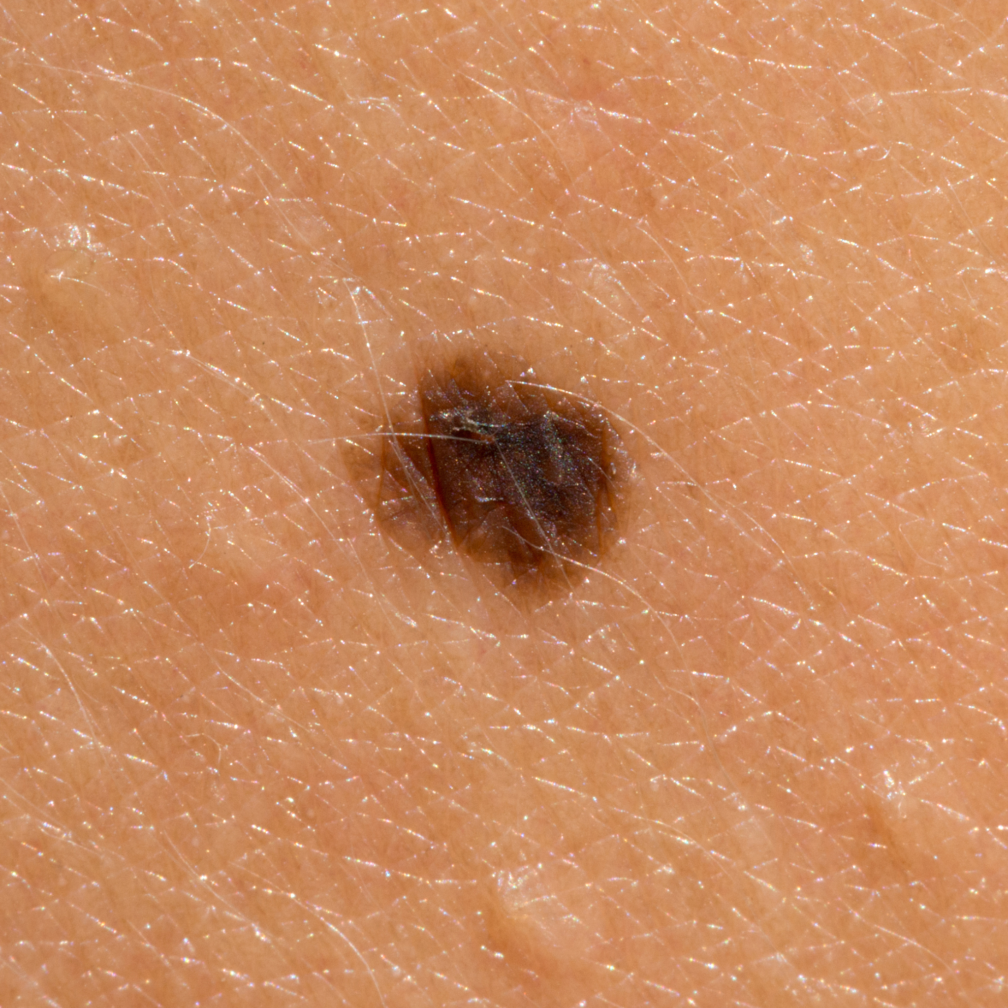 melanoma mole