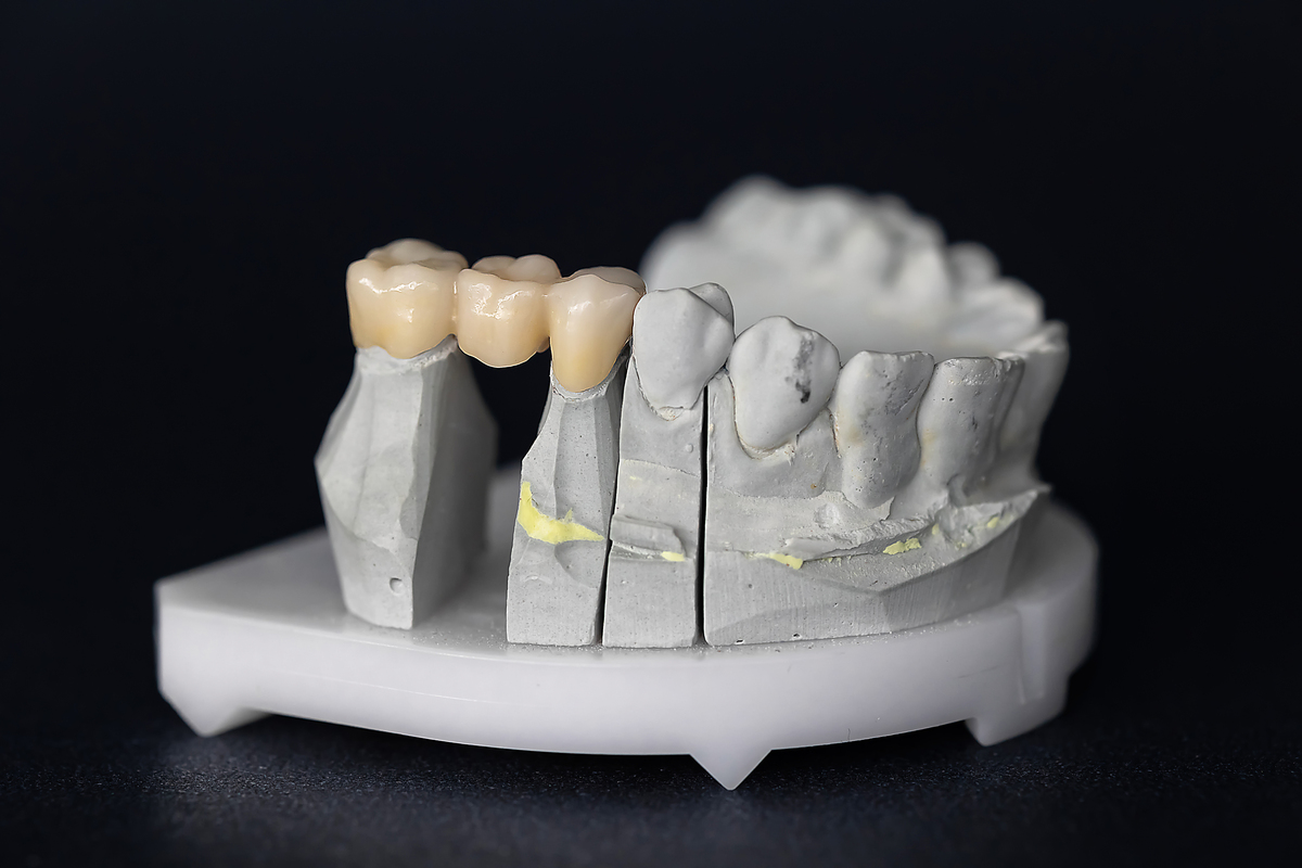 齿科3D打印技术：应用、工艺流程及未来展望
