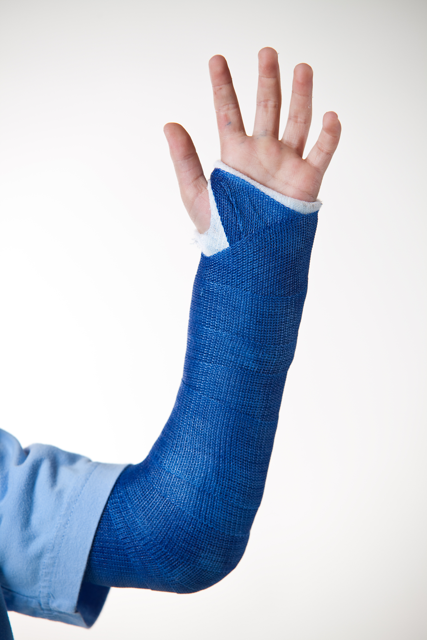 broken arm in cast