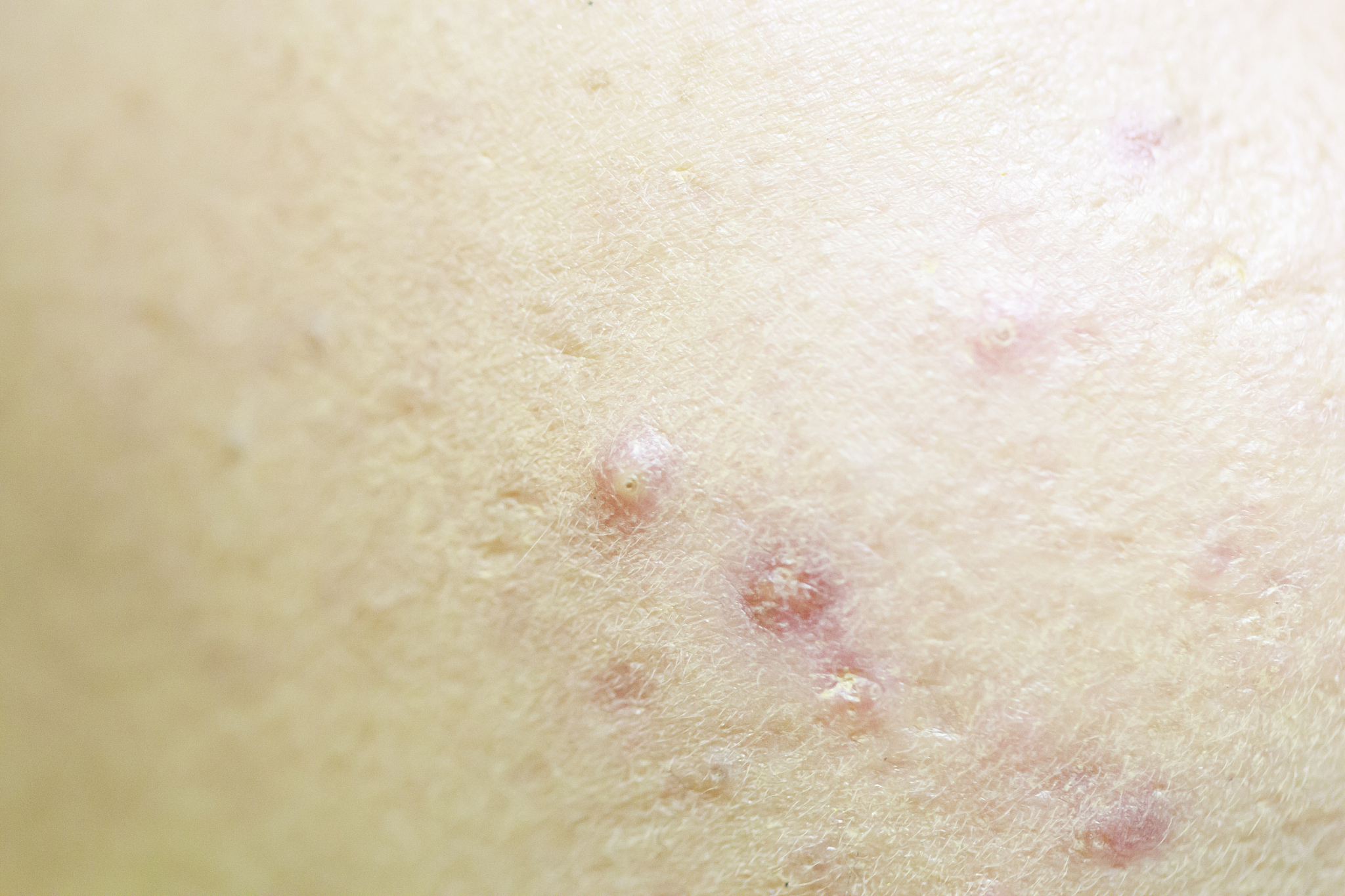 closeup acne inflammation on the face
