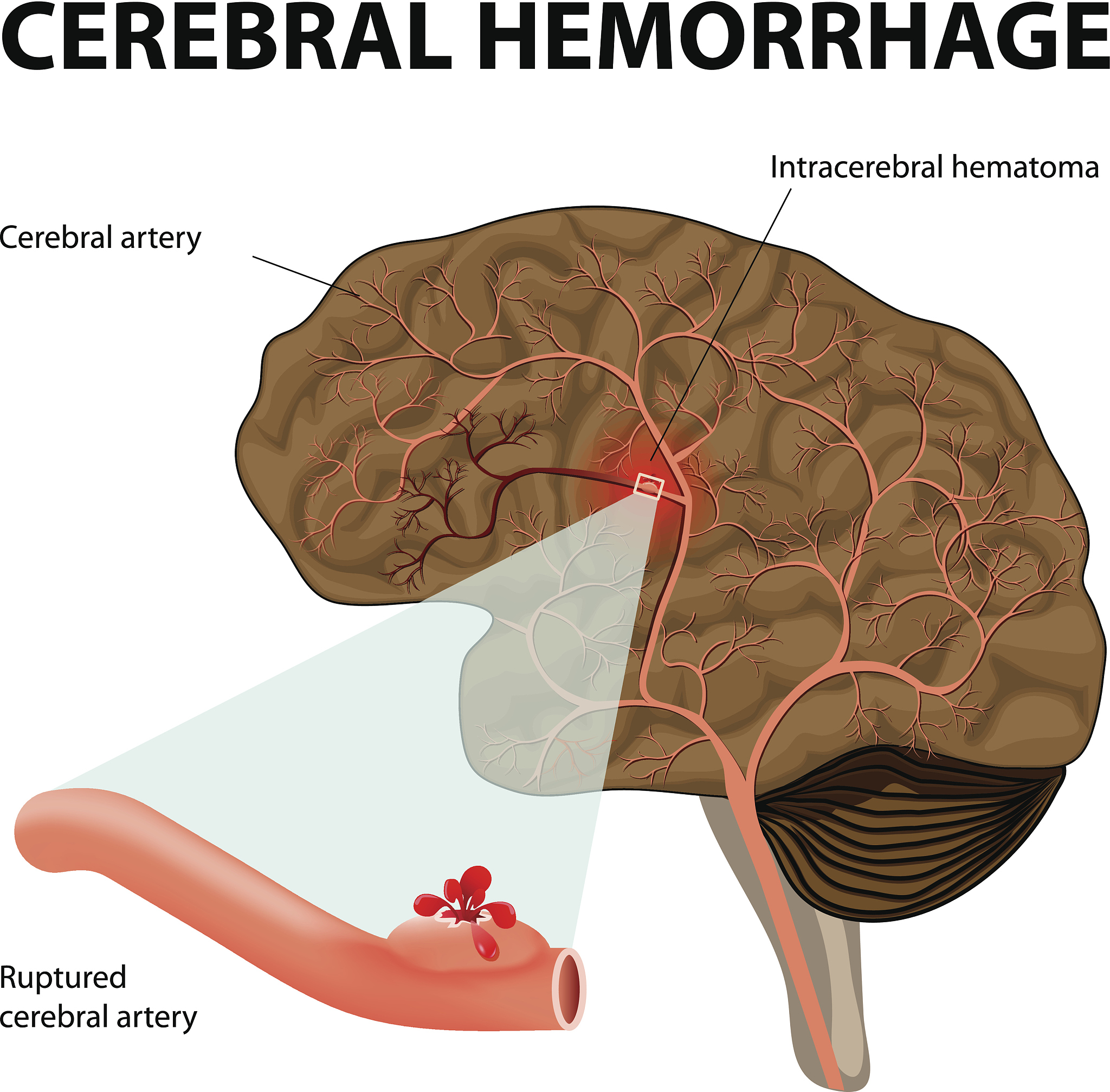 高血压脑恶性淋巴瘤患者疼痛管理指南