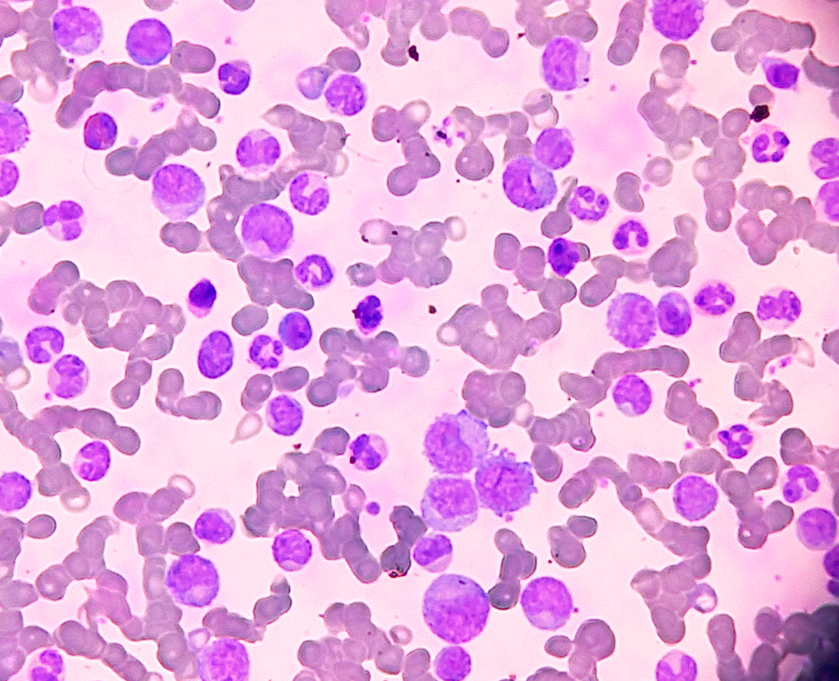 白血病分类：常见类型及概述