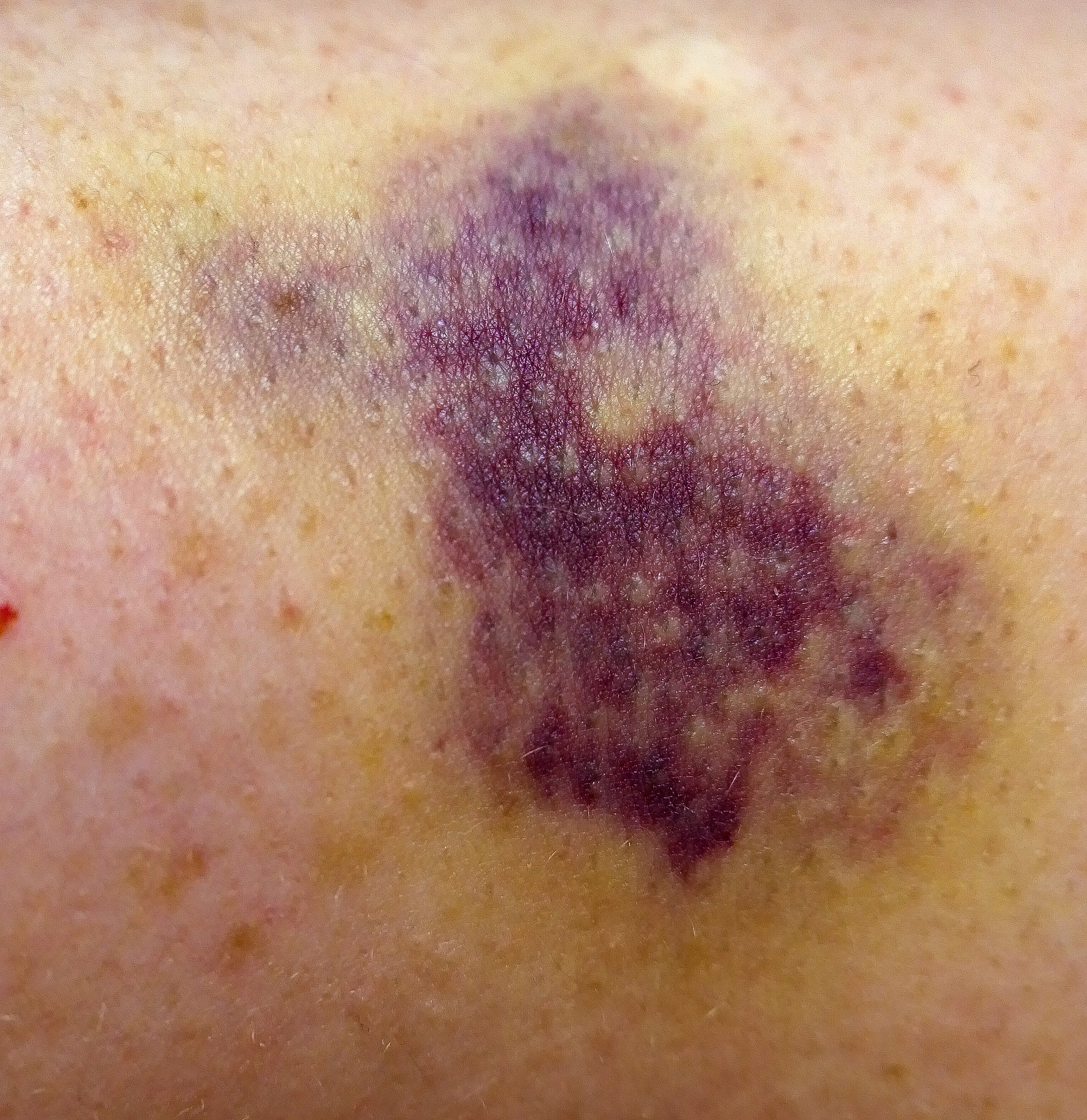 如何判断深部脓肿已经形成