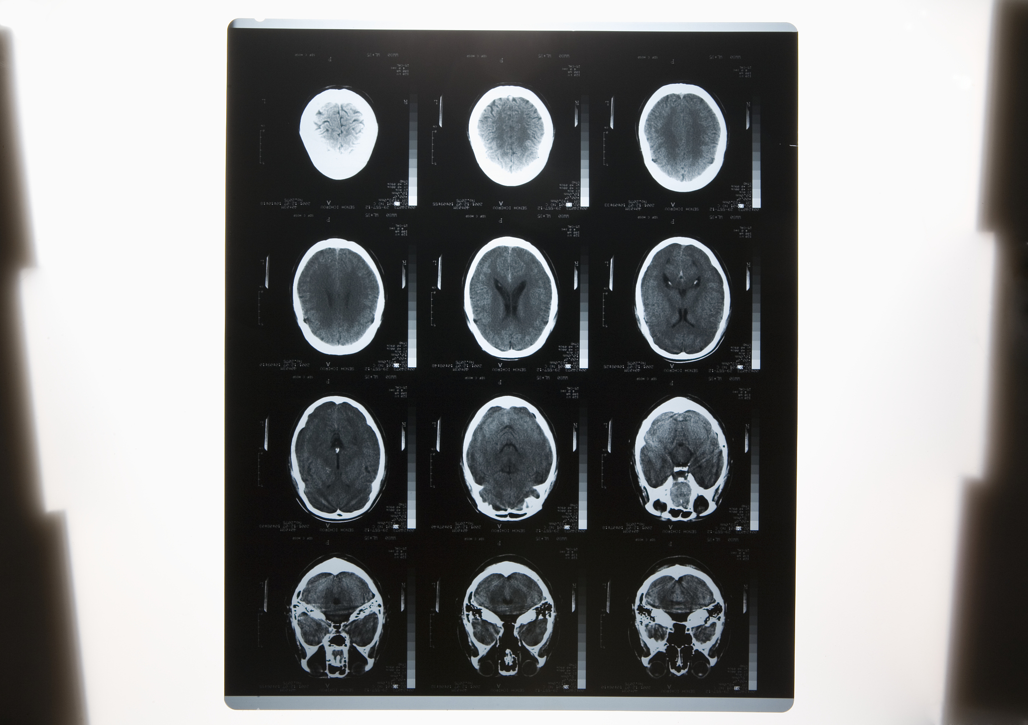 然而由于乳腺X线摄影图像中乳腺周围腺体遮蔽以及病变组织重叠的影响这些模型的性能在某些情况下可能会受到限制。已有研究中常用的两大公开数据集INbreast和DDSM8 9中收集的病例多为欧美女性乳腺X线FFDM图像。与致密型居多的亚洲女性乳腺不同欧美女性乳腺多为脂肪型形态构成差异较大脂肪型乳腺的FFDM图像中肿块辨识度高医生可以方便的手工标注出肿块的位置而致密型乳腺的FFDM图像中的肿块难以通过肉眼