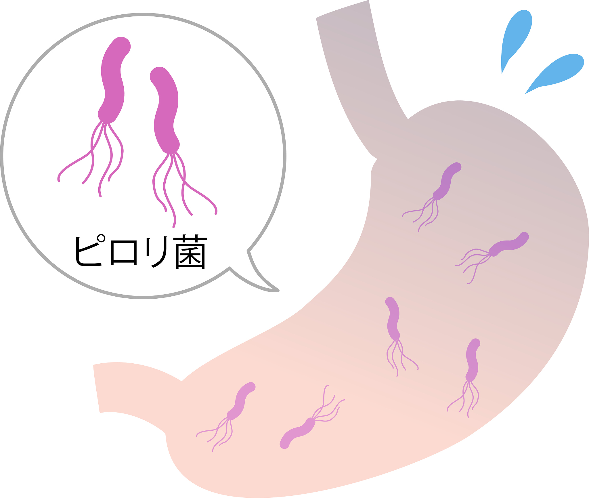 幽门螺杆菌感染？3个关键点助你轻松根除！