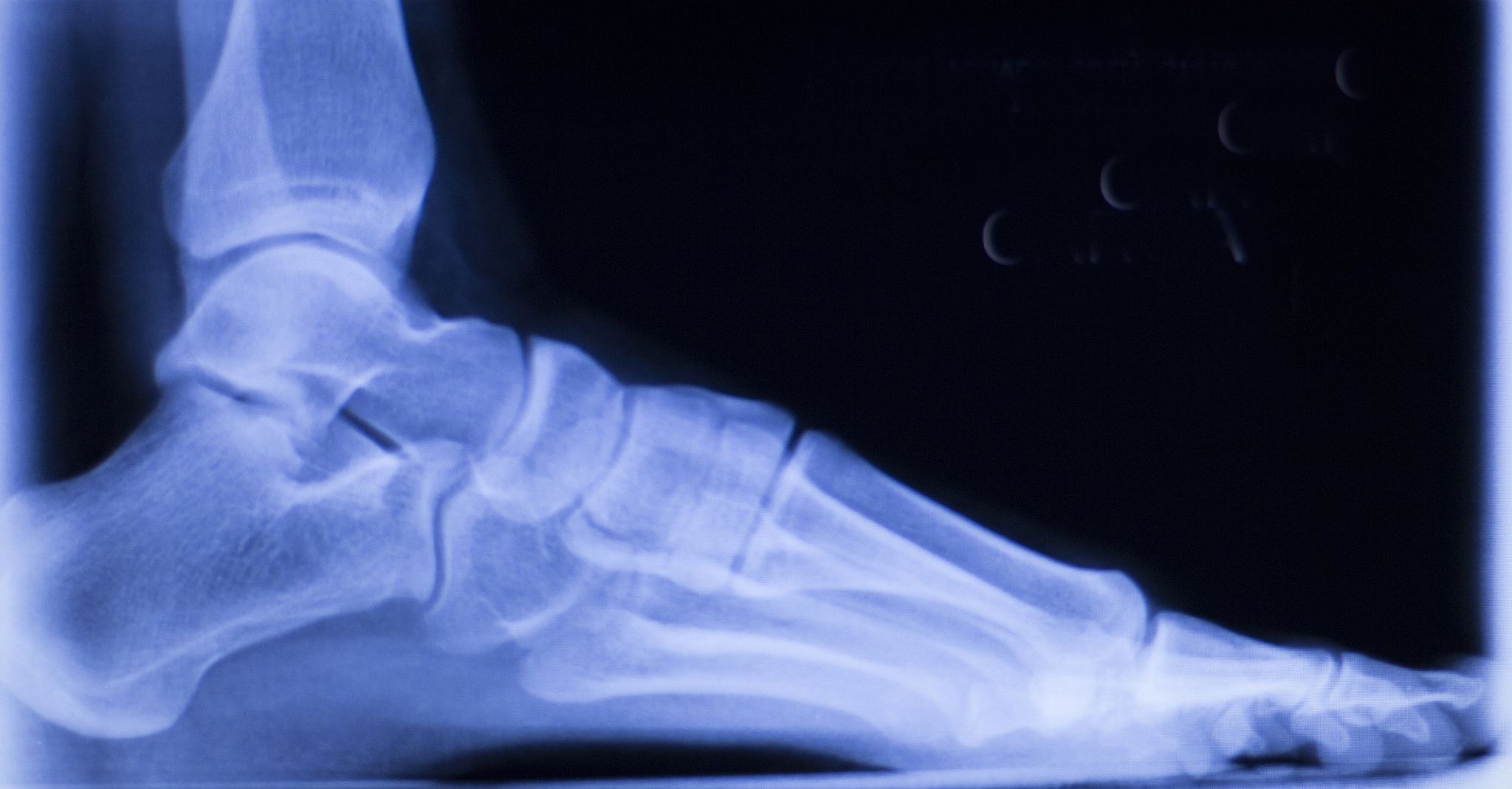 Stable Diffusion of Feet and Toes: Understanding Weight Distribution for Healthy Feet