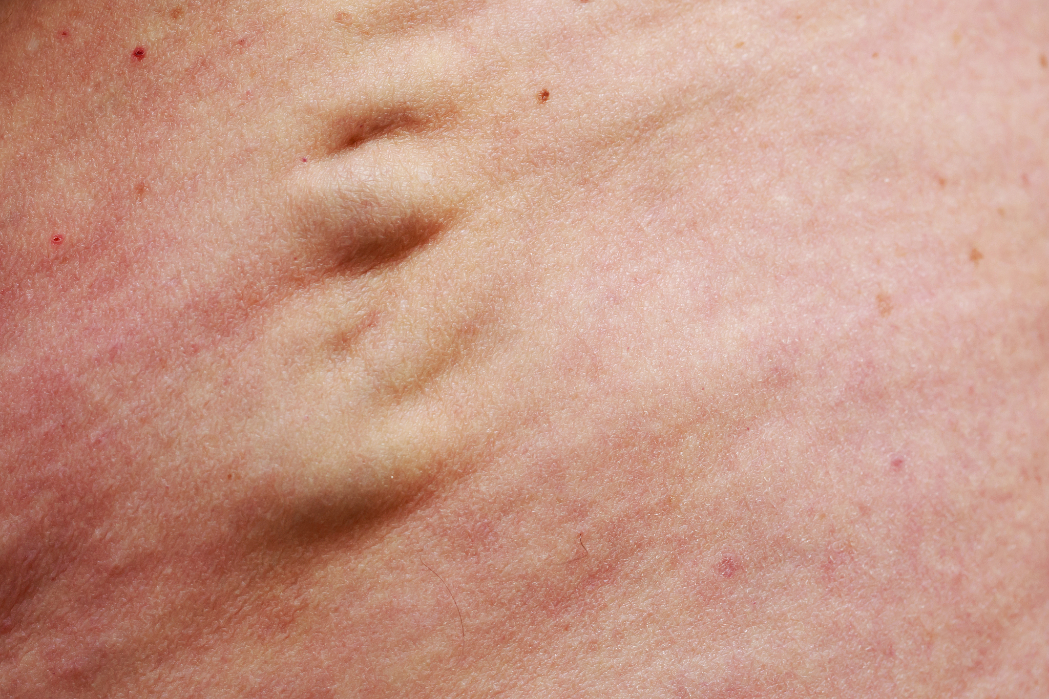 the varicose veins