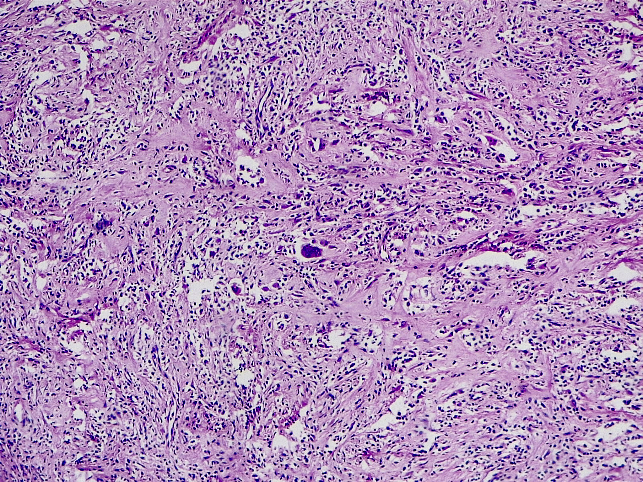 慢性肉芽肿性炎：症状、原因、治疗和诊断