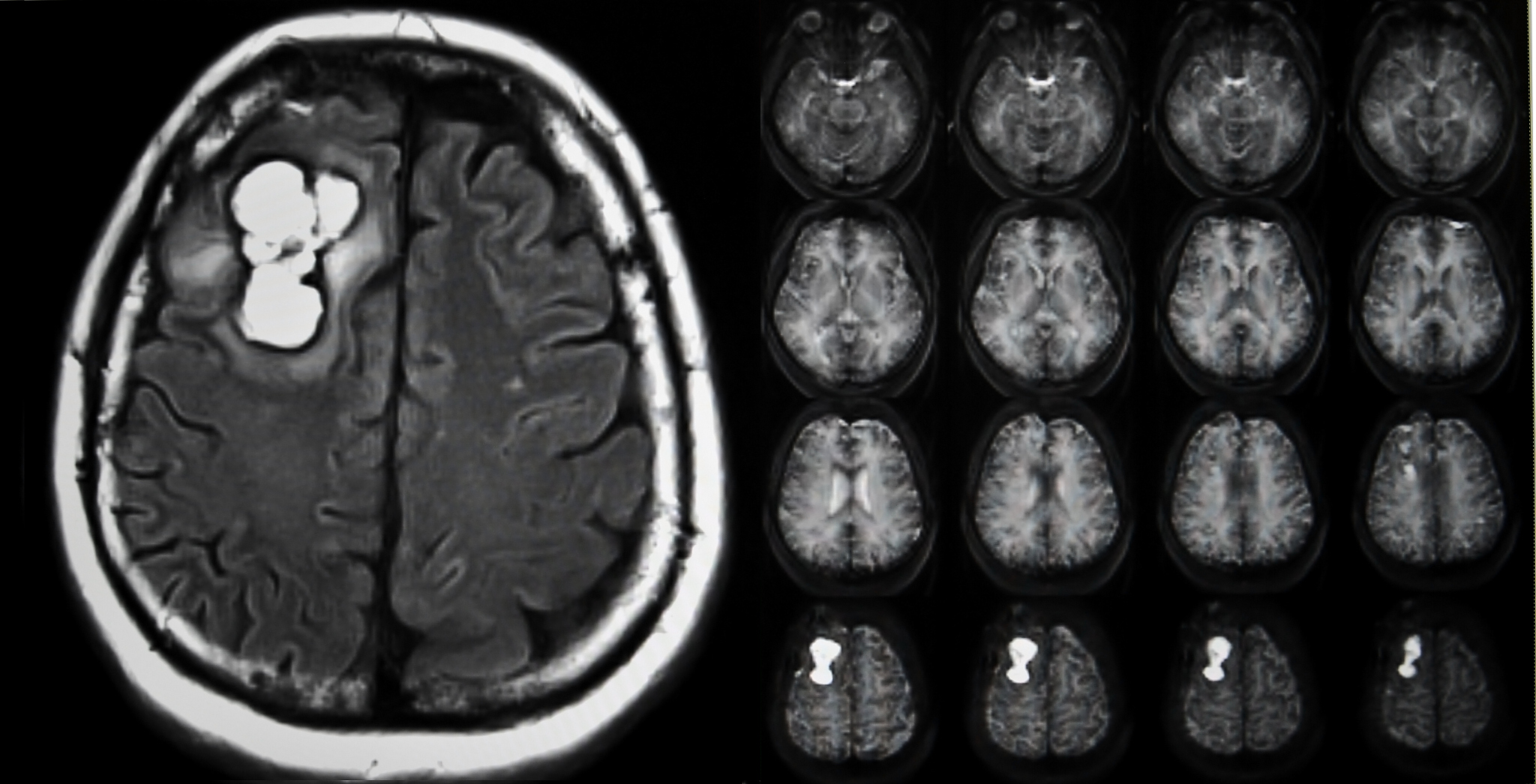 腺泡状软组织肉瘤的 CT、MR 特征分析：文献综述与讨论