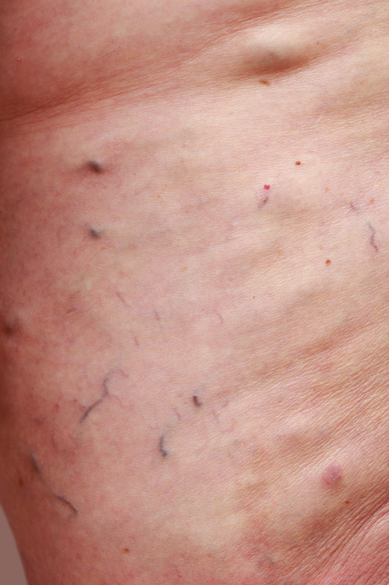 the varicose veins