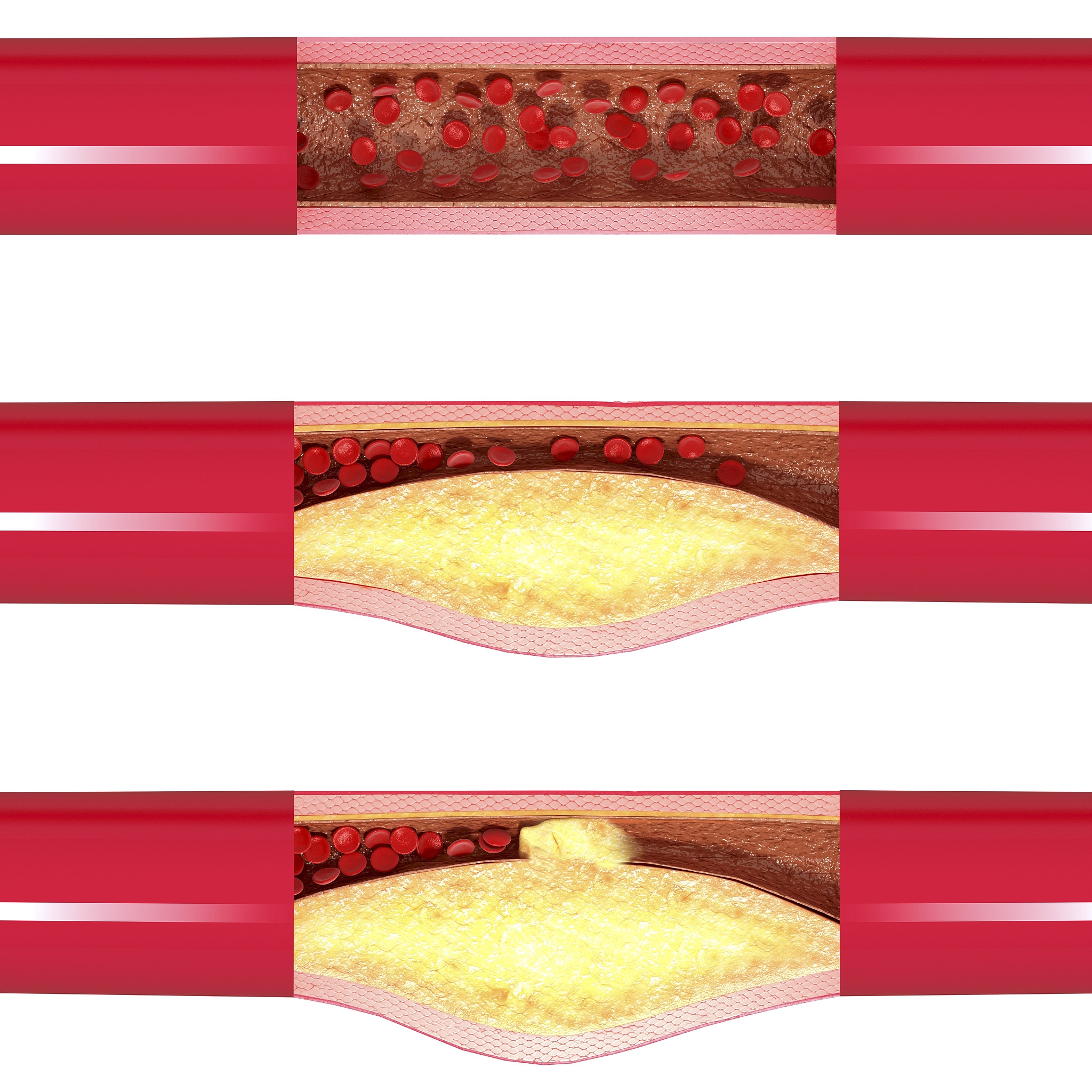 颈动脉斑块破裂导致卒中的连锁反应：新生血管、血栓和溃疡