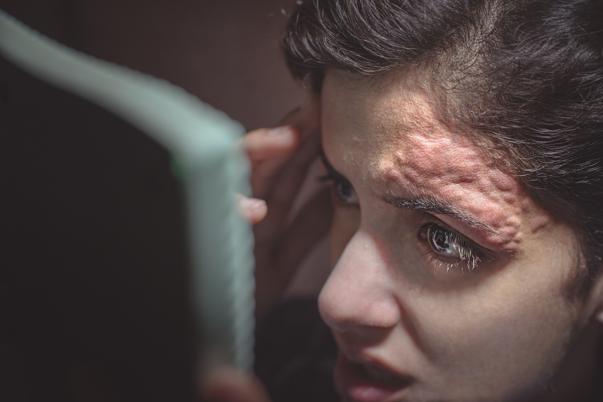 皮肤牵引护理：如何预防皮炎和溃疡