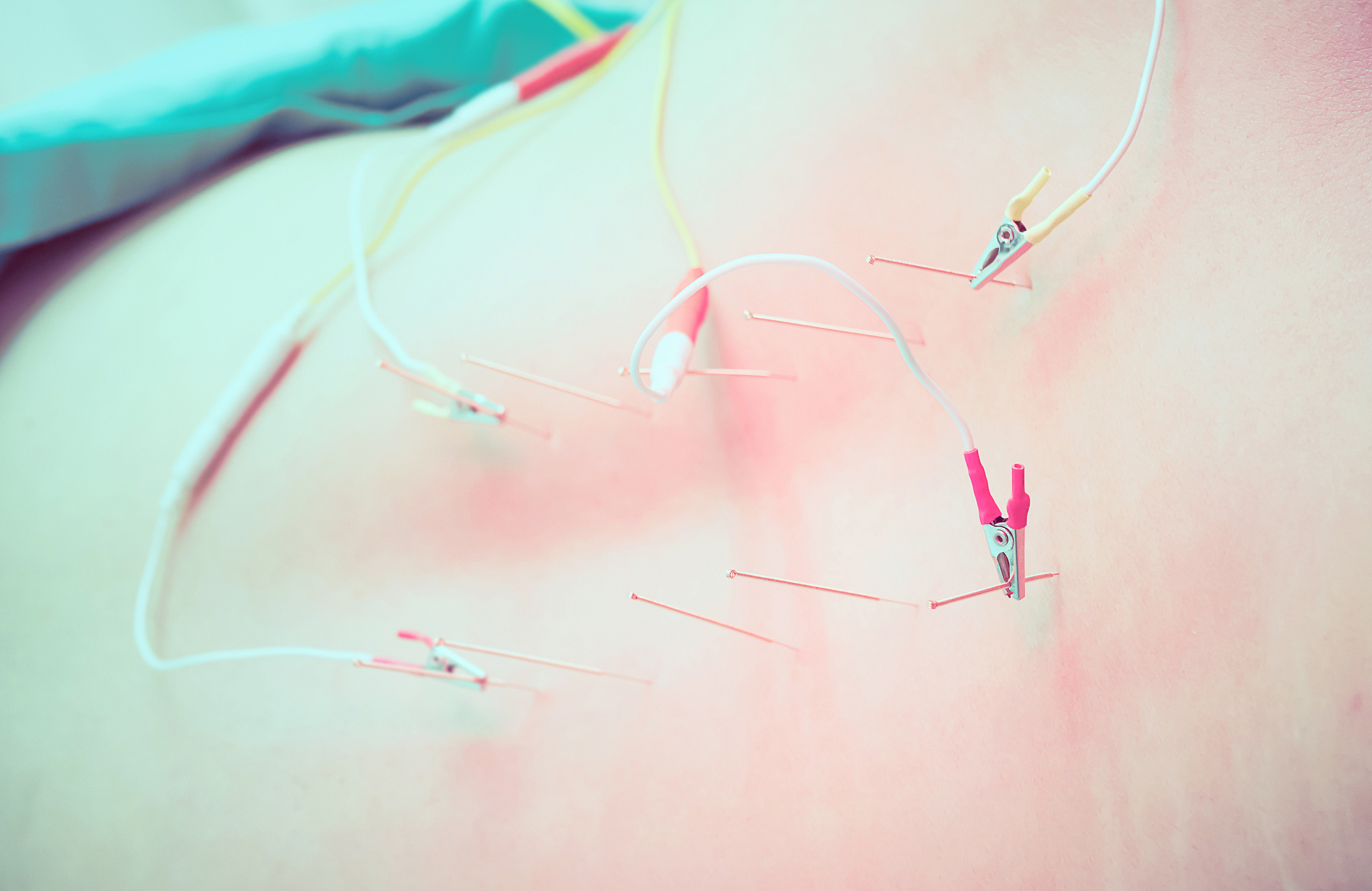 midsection of person with acupuncture needles on back