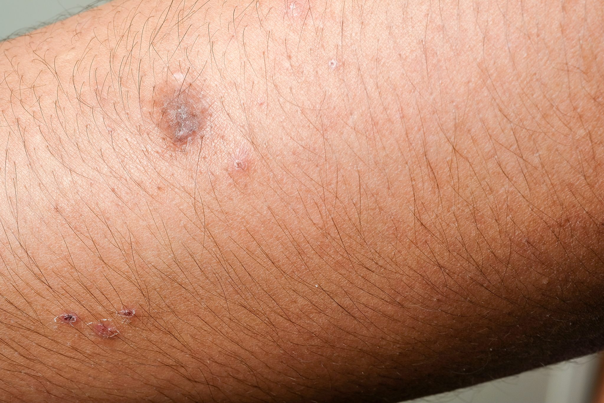 closeup dermatitis detail