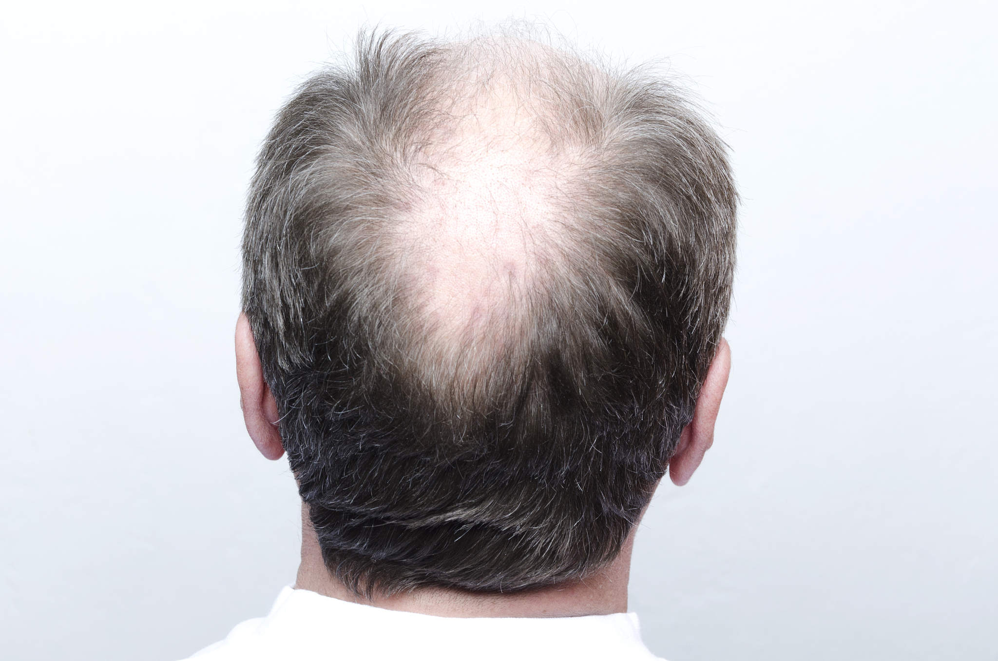 雄激素脱发2级怎么治疗