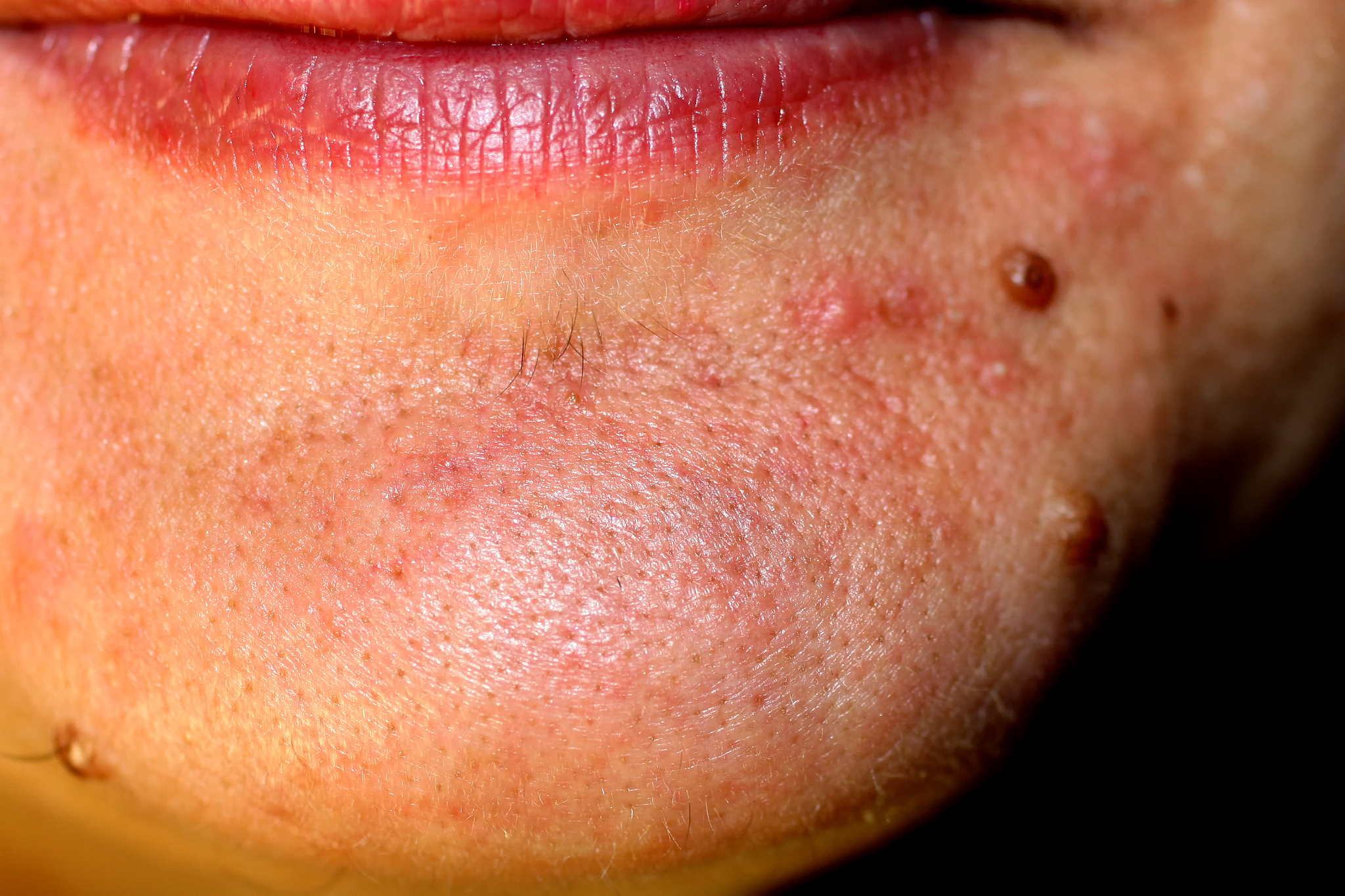 嘴下面有痣是什么意思