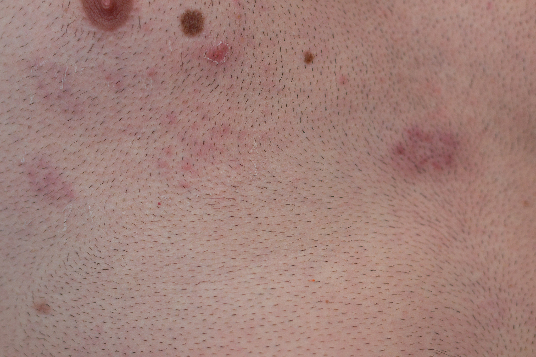 疱疹多久能好？了解疱疹的恢复时间和治疗方法