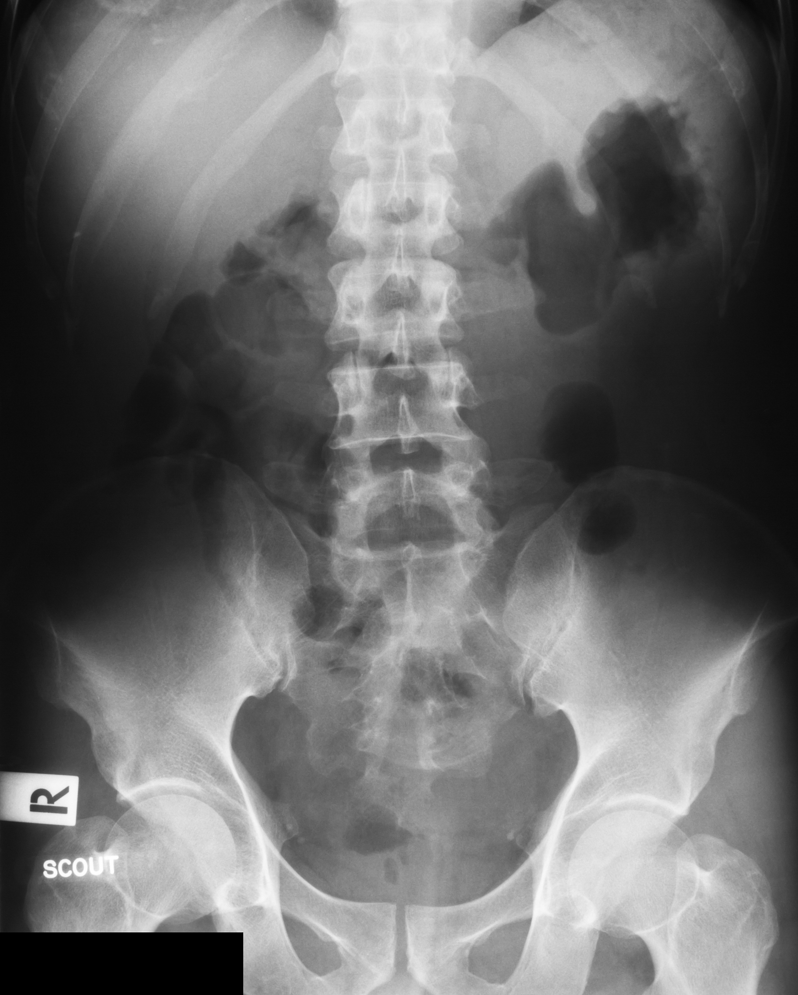 肾积水治疗方法：药物、手术、中医、营养