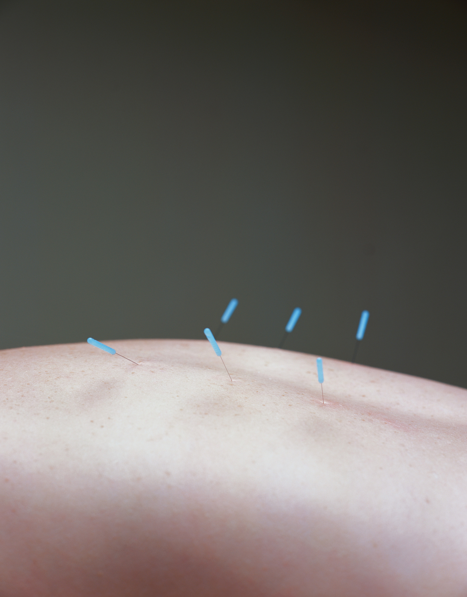 back acupuncture