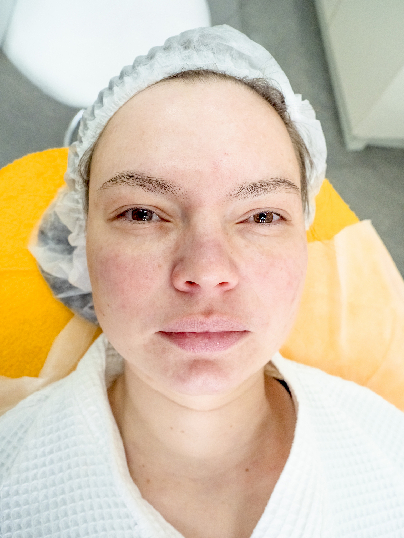 怎么让下眼袋消肿快