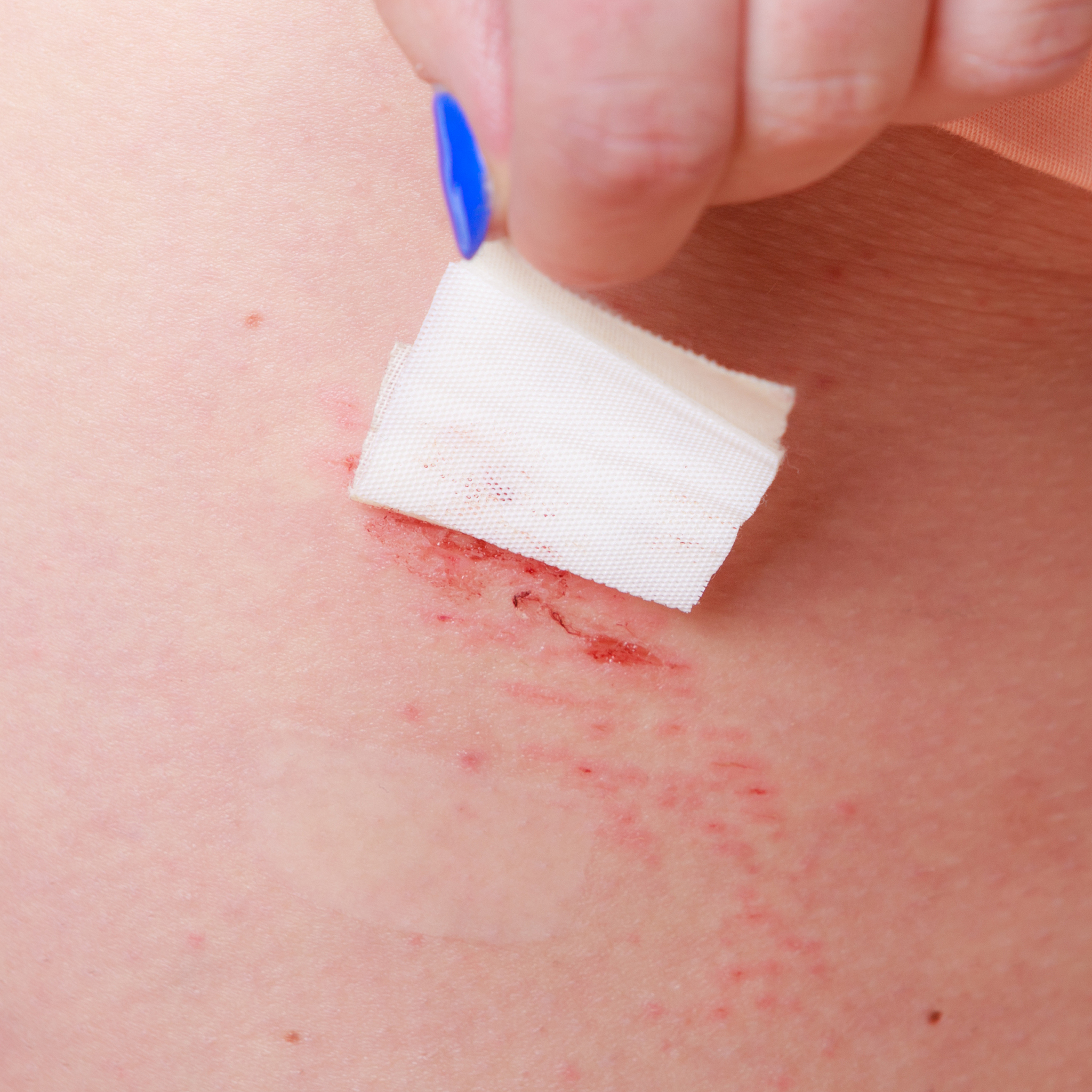 如何有效减少伤口疤痕？最全结疤方式指南