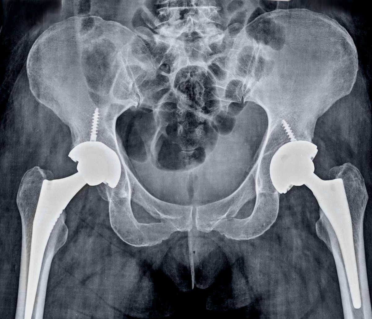 半髋关节置换：高龄髋部骨折的有效治疗方法