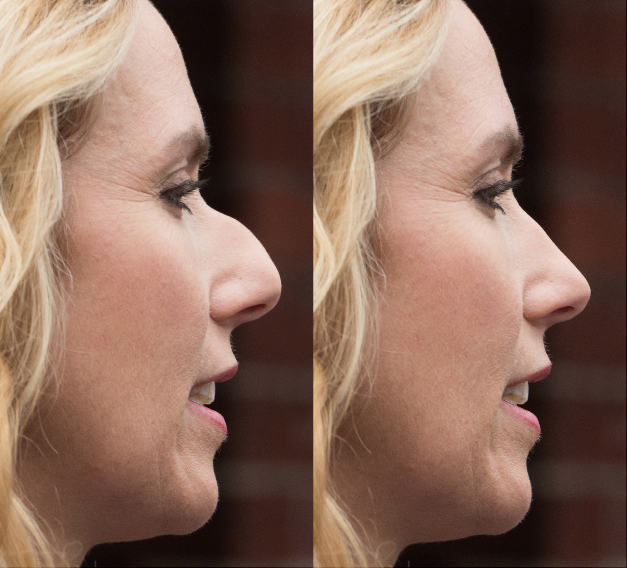 肋软骨隆鼻，朋友圈爆款！安全自然，恢复快！