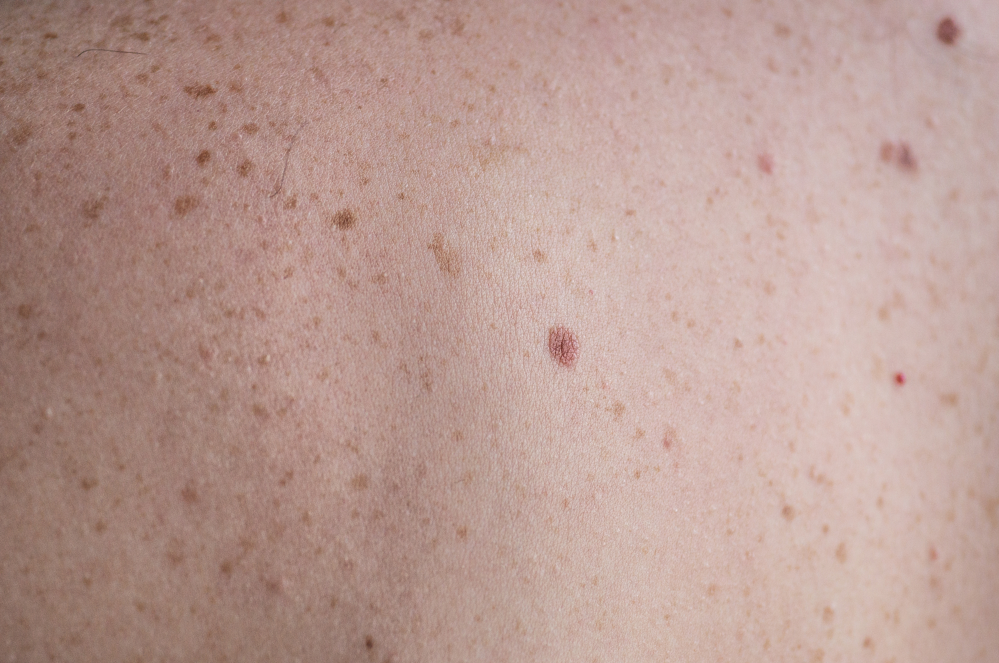 checking benign moles. close up detail of the bare skin on a man