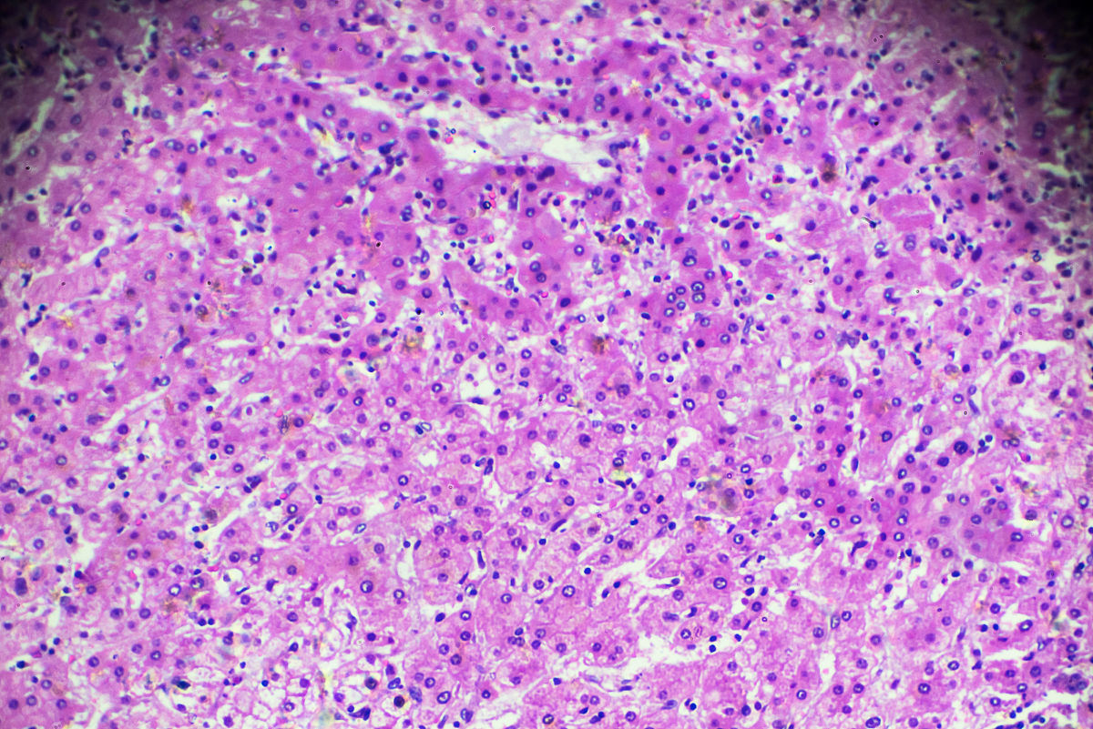 三阴性肝癌的临床特征和预后分析：一项基于271例原发性肝癌患者的研究