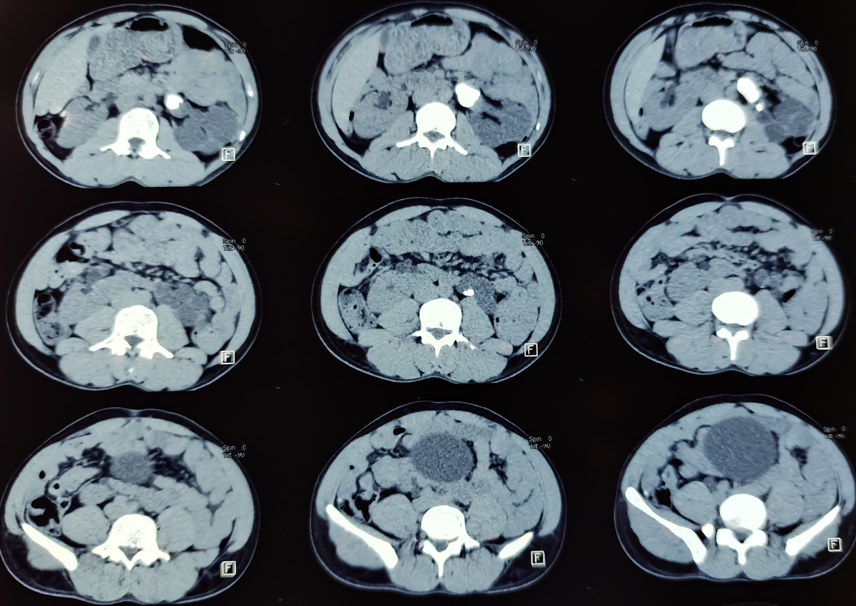 钆造影剂损伤肾脏和肝脏损害的原理